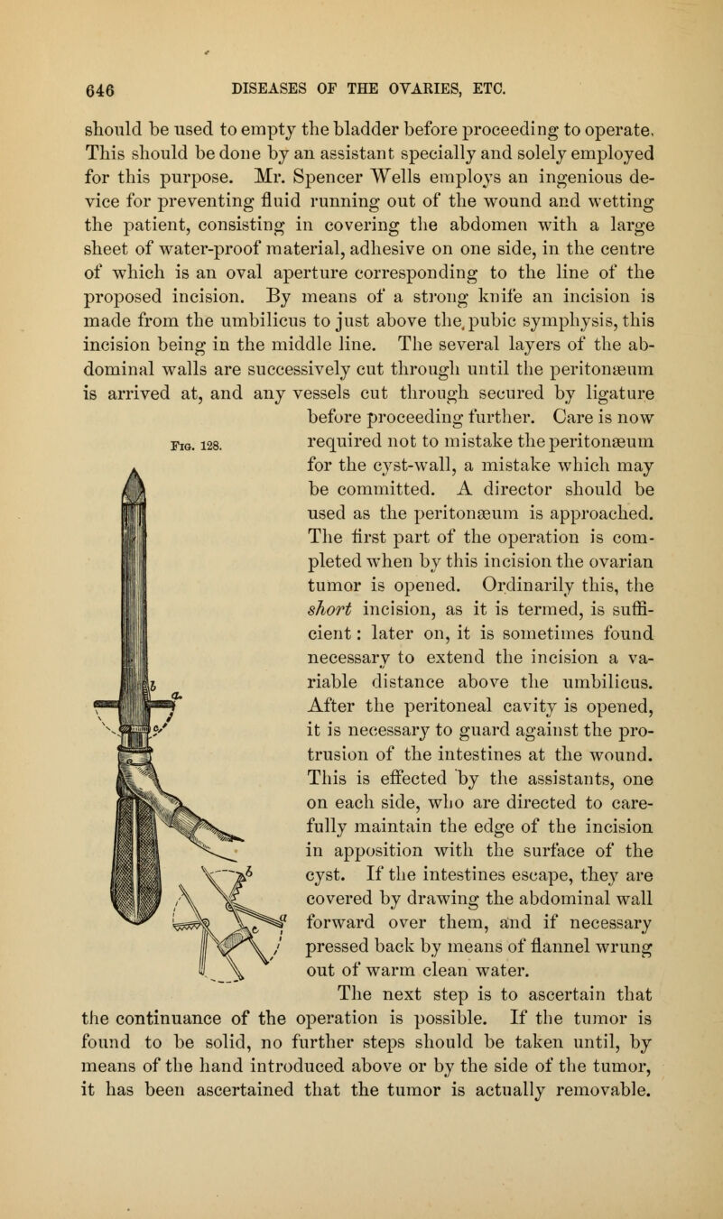 Fig. 128. should be used to empty the bladder before proceeding to operate, This should be done by an assistant specially and solely employed for this purpose. Mr. Spencer Wells employs an ingenious de- vice for preventing fluid running out of the wound and wetting the patient, consisting in covering the abdomen with a large sheet of water-proof material, adhesive on one side, in the centre of which is an oval aperture corresponding to the line of the proposed incision. By means of a strong knife an incision is made from the umbilicus to just above the, pubic symphysis, this incision being in the middle line. The several layers of the ab- dominal walls are successively cut through until the peritonaeum is arrived at, and any vessels cut through secured by ligature before proceeding further. Care is now required not to mistake the peritonaeum for the cyst-wall, a mistake which may be committed. A director should be used as the peritonaeum is approached. The h'rst part of the operation is com- pleted when by this incision the ovarian tumor is opened. Ordinarily this, the short incision, as it is termed, is suffi- cient : later on, it is sometimes found necessary to extend the incision a va- riable distance above the umbilicus. After the peritoneal cavity is opened, it is necessary- to guard against the pro- trusion of the intestines at the wound. This is effected by the assistants, one on each side, who are directed to care- fully maintain the edge of the incision in apposition with the surface of the cyst. If the intestines escape, they are covered by drawing the abdominal wall forward over them, and if necessary pressed back by means of flannel wrung out of warm clean water. The next step is to ascertain that the continuance of the operation is possible. If the tumor is found to be solid, no further steps should be taken until, by means of the hand introduced above or by the side of the tumor, it has been ascertained that the tumor is actually removable.