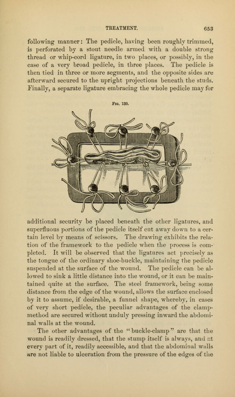 following manner: The pedicle, having been roughly trimmed, is perforated by a stout needle armed with a double strong thread or whip-cord ligature, in two places, or possibly, in the case of a very broad pedicle, in three places. The pedicle is then tied in three or more segments, and the opposite sides are afterward secured to the upright projections beneath the studs. Finally, a separate ligature embracing the whole pedicle may for Fig. 130. additional security be placed beneath the other ligatures, and superfluous portions of the pedicle itself cut away down to a cer- tain level by means of scissors. The drawing exhibits the rela- tion of the framework to the pedicle when the process is com- pleted. It will be observed that the ligatures act precisely as the tongue of the ordinary shoe-buckle, maintaining the pedicle suspended at the surface of the wound. The pedicle can be al- lowed to sink a little distance into the wound, or it can be main- tained quite at the surface. The steel framework, being some distance from the edge of the wound, allows the surface enclosed by it to assume, if desirable, a funnel shape, whereby, in cases of very short pedicle, the peculiar advantages of the clamp- method are secured without unduly pressing inward the abdomi- nal walls at the wound. The other advantages of the buckle-clamp are that the wound is readily dressed, that the stump itself is always, and at every part of it, readily accessible, and that the abdominal walls are not liable to ulceration from the pressure of the edges of the