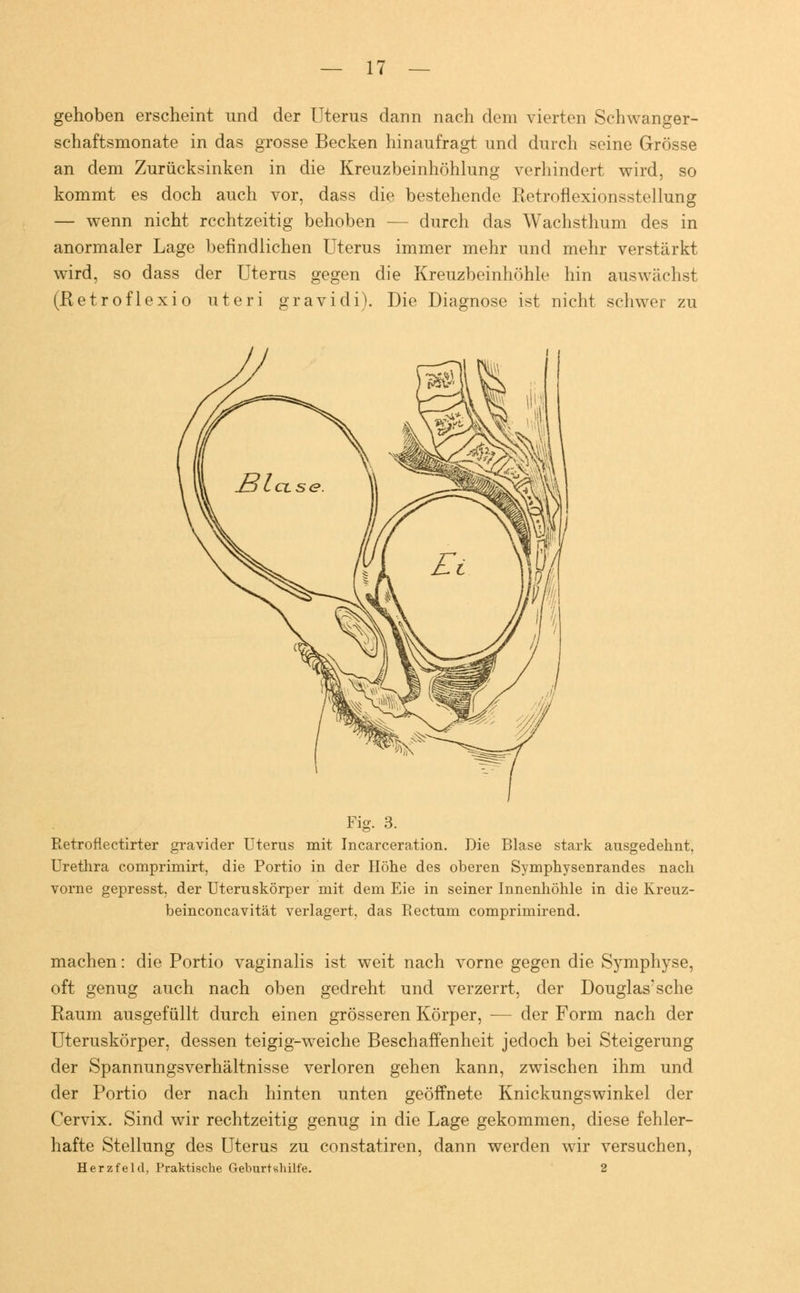 gehoben erscheint und der Uterus dann nach dem vierten Schwanger- schaftsmonate in das grosse Becken hinaufragt und durch seine Grösse an dem Zurücksinken in die Kreuzbeinhöhlung verhindert wird, so kommt es doch auch vor, dass die bestehende Retroflexionsstellung — wenn nicht rechtzeitig behoben — durch das Wachsthum des in anormaler Lage befindlichen Uterus immer mehr und mehr verstärkt wird, so dass der Uterus gegen die Kreuzbeinhöhle hin auswächst (ßetroflexio uteri gravidi). Die Diagnose ist nicht schwer zu Fig. 3. Retroflectirter gravider Uterus mit Incarceration. Die Blase stark ausgedehnt, Urethra cornprimirt. die Portio in der Höhe des oberen Symphysenrandes nach vorne gepresst. der Uteruskörper mit dem Eie in seiner Innenhöhle in die Kreuz- beinconeavität verlagert, das Rectum comprimirend. machen: die Portio vaginalis ist weit nach vorne gegen die Symphyse, oft genug auch nach oben gedreht und verzerrt, der Douglas?sche Raum ausgefüllt durch einen grösseren Körper, — der Form nach der Uteruskörper, dessen teigig-weiche Beschaffenheit jedoch bei Steigerung der Spannungsverhältnisse verloren gehen kann, zwischen ihm und der Portio der nach hinten unten geöffnete Knickungswinkel der Cervix. Sind wir rechtzeitig genug in die Lage gekommen, diese fehler- hafte Stellung des Uterus zu constatiren, dann werden wir versuchen, Herzfeld, Praktische Geburtshilfe. 2