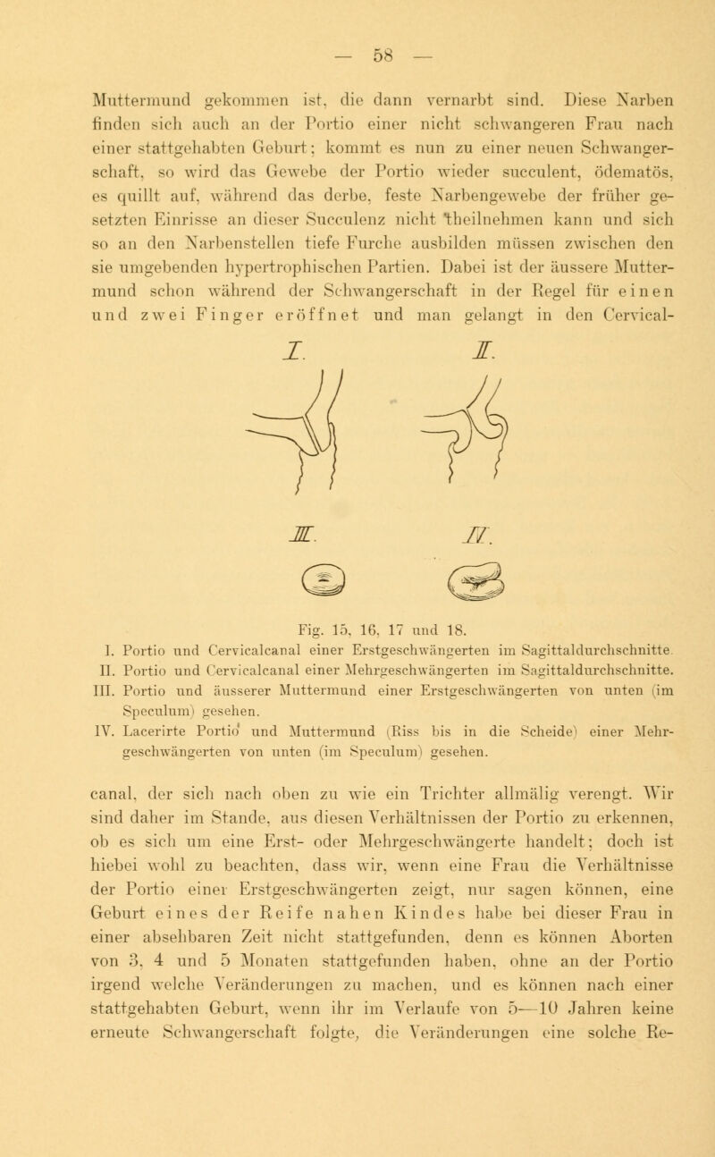 Muttermund gekommen ist. die dann vernarbt sind. Diese Narben rinden sich auch an der Portio einer nicht schwangeren Frau nach einei- stattgehabten Geburt: kommt es nun zu einer neuen Schwanger- schaft, so wird das Gewebe der Portio wieder succulent, ödematös, es quillt auf, während das derbe, feste Xarbengewebe der früher ge- setzten Einrisse an dieser Succulenz nicht 'theilnehmen kann und sich so an den Xarbenstellen tiefe Furche ausbilden müssen zwischen den sie umgebenden hypertrophischen Partien. Dabei ist der äussere Mutter- mund schon während der Schwangerschaft in der Regel für einen und zwei Finger eröffnet und man gelangt in den Cervical- M. II. Fig. 15. 16. 17 und 18. I. Portio und Cervicalcanal einer Erstgeschwängerten im Sagittaldurchsehnitte. II. Portio und Cervicalcanal einer Mehrgeschwängerten im Sagittaldurchsehnitte. III. Portio und äusserer Muttermund einer Erstgeschwängerten von unten (im Speculum) gesehen. 1Y. Lacerirte Portio und Muttermund (Riss bis in die Scheide' einer Mehr- geschwängerten von unten (im SpeculunO gesehen. canal, der sich nach oben zu wie ein Trichter allmälig verengt. Wir sind daher im Stande, aus diesen Verhältnissen der Portio zu erkennen, ob es sich um eine Erst- oder Mehrgeschwängerte handelt; doch ist hiebei wohl zu beachten, dass wir. wenn eine Frau die Verhältnisse der Portio einer Erstgeschwängerten zeigt, nur sagen können, eine Geburt eines der Reife nahen Kindes habe bei dieser Frau in einer absehbaren Zeit nicht stattgefunden, denn es können Aborten von 3. 4 und 5 Monaten stattgefunden haben, ohne an der Portio irgend welche Veränderungen zu machen, und es können nach einer stattgehabten Geburt, wenn ihr im Verlaufe von 5—10 Jahren keine erneute Schwangerschaft folgte, die Veränderungen eine solche Re-