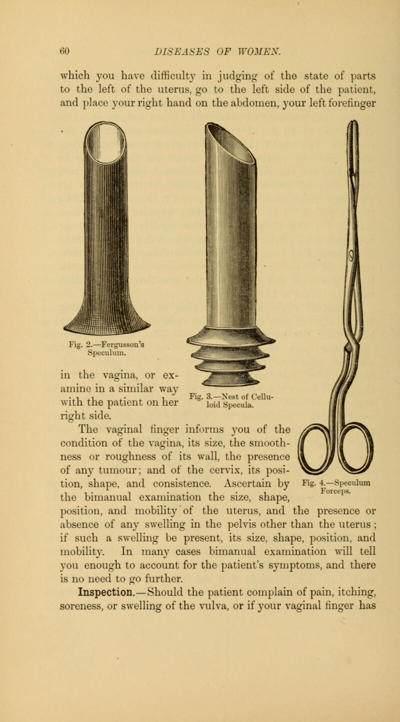 which you have difficulty in judging of the state of parts to the left of the uterus, go to the left side of the patient, and place your right hand on the abdomen, your left forefinger Fig. 2.—Fergusson's Speculum. in the vagina, or ex- amine in a similar way ..-. .1 .. i Fig. 3.—Xest of Cellu- witn the patient on her i0id Specula. right side. The vaginal finger informs you of the condition of the vagina, its size, the smooth- ness or roughness of its wall, the presence of any tumour; and of the cervix, its posi- tion, shape, and consistence. Ascertain by the bimanual examination the size, shape, position, and mobility of the uterus, and the presence or absence of any swelling in the pelvis other than the uterus ; if such a swelling be present, its size, shape, position, and mobility. In many cases bimanual examination will tell you enough to account for the patient's symptoms, and there is no need to go further. Inspection.—Should the patient complain of pain, itching, soreness, or swelling of the vulva, or if your vaginal finger has 4.—Speculum Forceps.