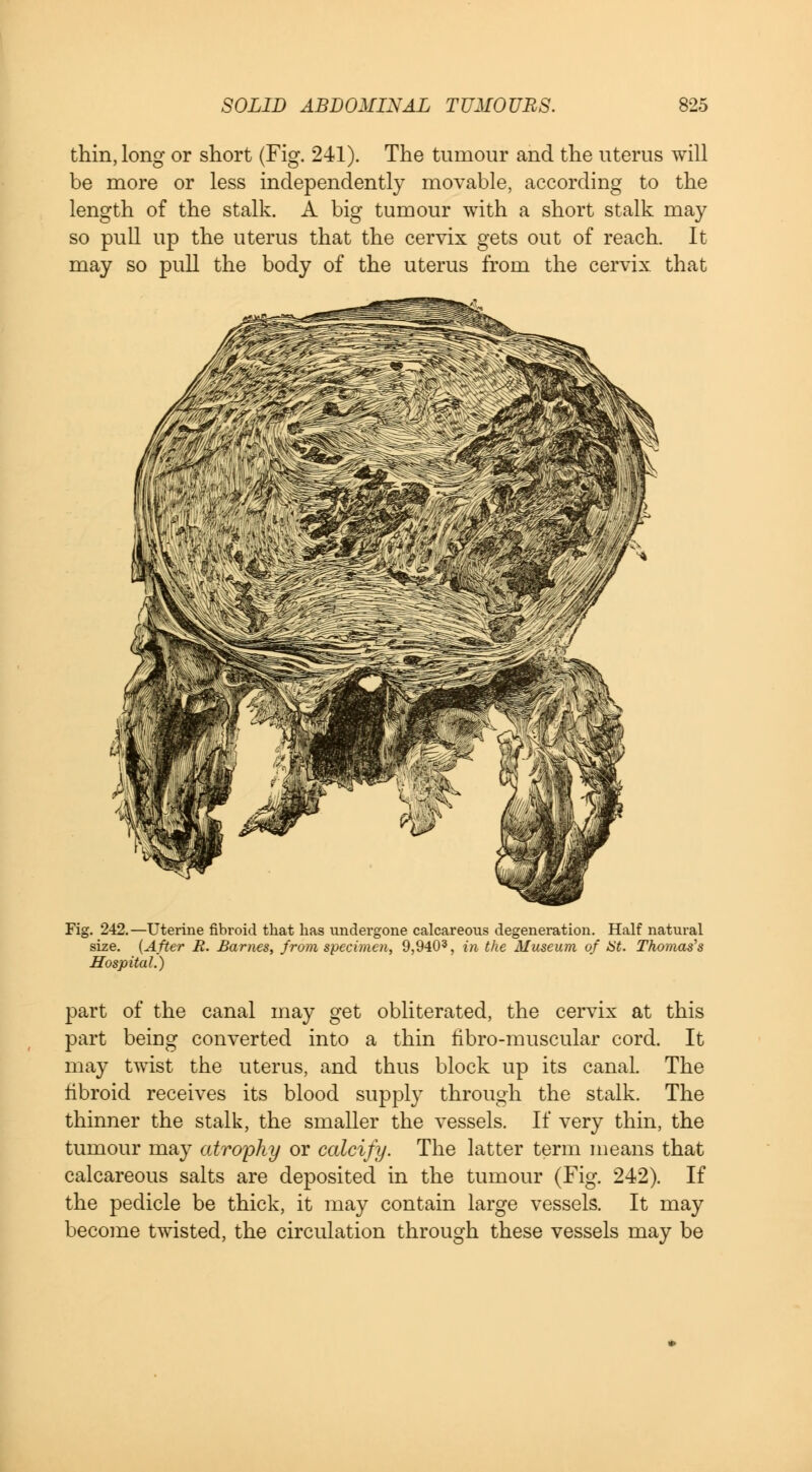 thin, long or short (Fig. 241). The tumour and the uterus will be more or less independently movable, according to the length of the stalk. A big tumour with a short stalk may so pull up the uterus that the cervix gets out of reach. It may so pull the body of the uterus from the cervix that Fig. 242.—Uterine fibroid that has undergone calcareous degeneration. Half natural size. (After R. Barnes, from specimen, 9,9403, in the Museum of iit. Thomas's Hospital.) part of the canal may get obliterated, the cervix at this part being converted into a thin fibro-muscular cord. It may twist the uterus, and thus block up its canal. The fibroid receives its blood supply through the stalk. The thinner the stalk, the smaller the vessels. If very thin, the tumour may atrophy or calcify. The latter term means that calcareous salts are deposited in the tumour (Fig. 242). If the pedicle be thick, it may contain large vessels. It may become twisted, the circulation through these vessels may be