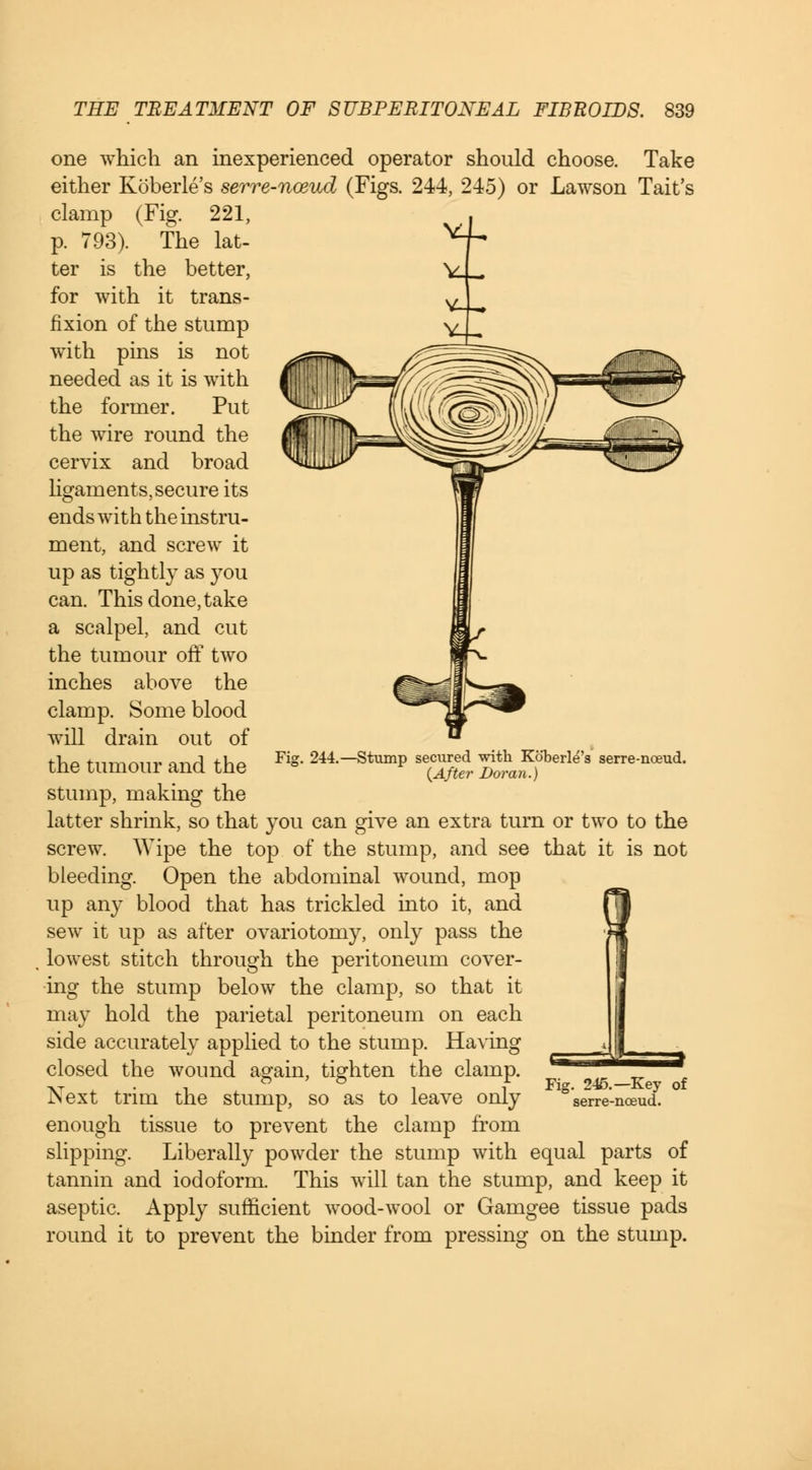 one which an inexperienced operator should choose. Take either Koberle's serre-nceud (Figs. 244, 245) or Lawson Tait's clamp (Fig. 221, p. 793). The lat- ter is the better, for with it trans- fixion of the stump with pins is not needed as it is with the former. Put the wire round the cervix and broad ligaments, secure its ends with the instru- ment, and screw it up as tightly as you can. This done, take a scalpel, and cut the tumour off two inches above the clamp. Some blood will drain out of the tumour and the stump, making the latter shrink, so that you can give an extra turn or two to the screw. Wipe the top of the stump, and see that it is not bleeding. Open the abdominal wound, mop up any blood that has trickled into it, and sew it up as after ovariotomy, only pass the lowest stitch through the peritoneum cover- ing the stump below the clamp, so that it may hold the parietal peritoneum on each side accurately applied to the stump. Having closed the wound again, tighten the clamp. Next trim the stump, so as to leave only enough tissue to prevent the clamp from slipping. Liberally powder the stump with equal parts of tannin and iodoform. This will tan the stump, and keep it aseptic. Apply sufficient wood-wool or Gamgee tissue pads round it to prevent the binder from pressing on the stump. Ffc 244.—Stump secured with Koberle's serre-nceud. (After Dor an.) Fig. 245 Key of serre-nceud.