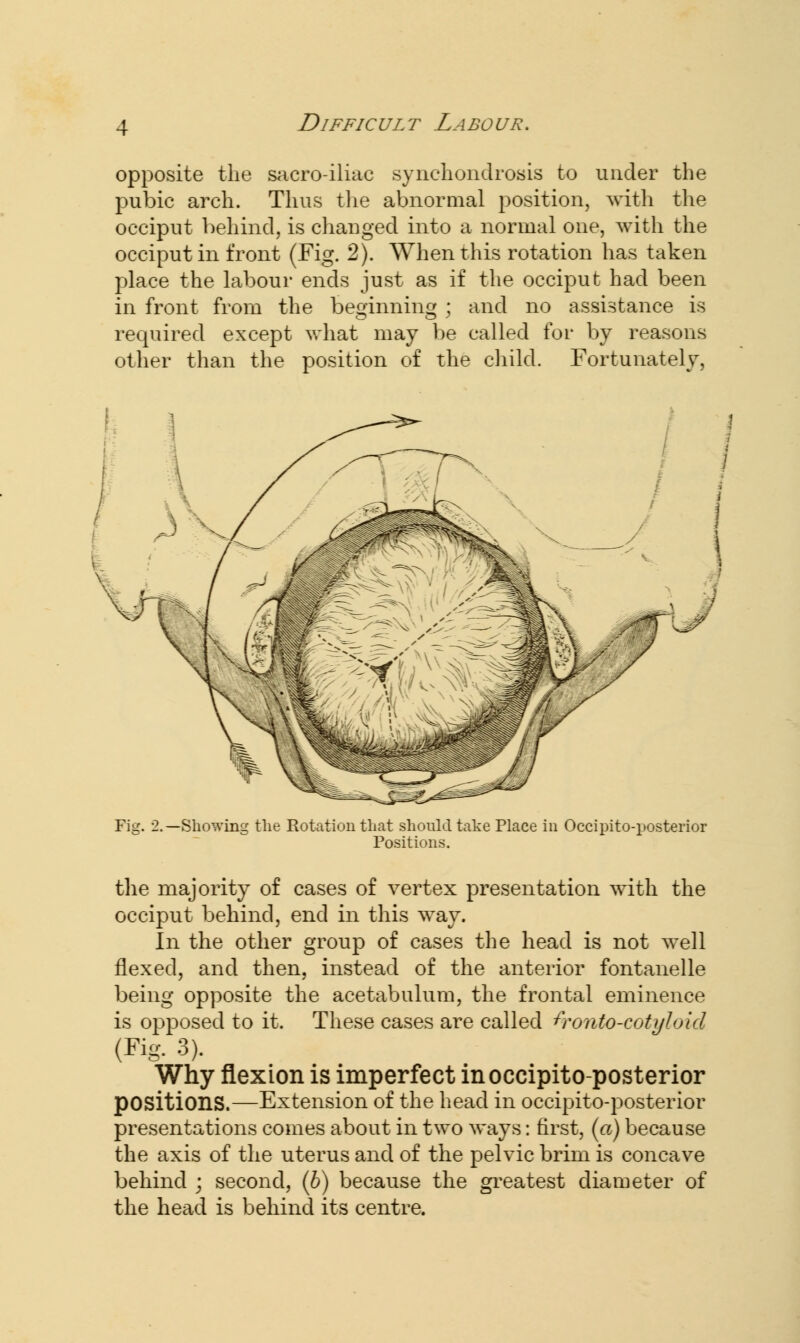 opposite the sacro-iliac synchondrosis to under the pubic arch. Thus the abnormal position, with the occiput behind, is changed into a normal one, with the occiput in front (Fig. 2). When this rotation has taken place the labour ends just as if the occiput had been in front from the beginning ; and no assistance is required except what may be called for by reasons other than the position of the child. Fortunately, Fig. 2.—Showing the Rotation that should take Place in Occipito-posterior Positions. the majority of cases of vertex presentation with the occiput behind, end in this way. In the other group of cases the head is not well flexed, and then, instead of the anterior fontanelle being opposite the acetabulum, the frontal eminence is opposed to it. These cases are called fronto-cotyloid (Fig. 3). Why flexion is imperfect in occipito-posterior positions.—Extension of the head in occipito-posterior presentations comes about in two ways: first, («) because the axis of the uterus and of the pelvic brim is concave behind ; second, (b) because the greatest diameter of the head is behind its centre.