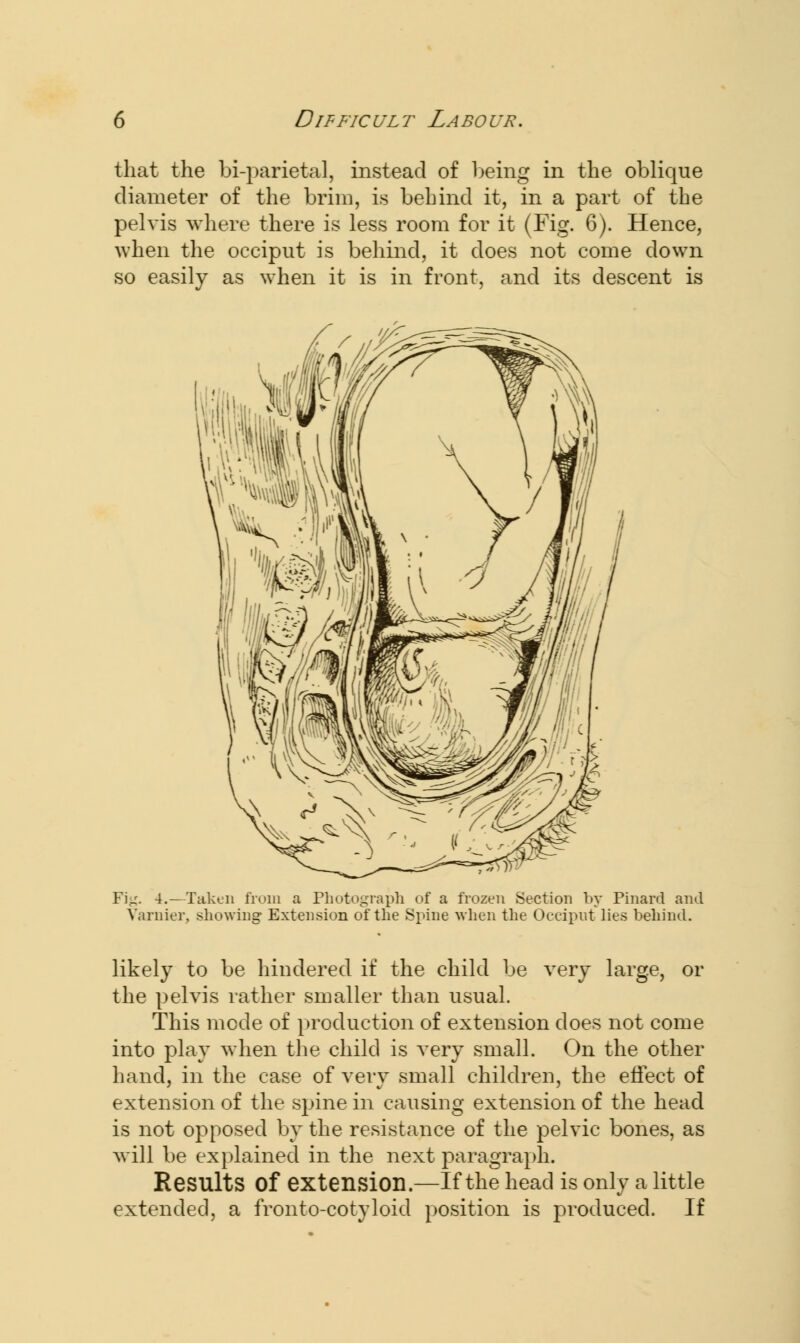 that the bi-parietal, instead of being in the oblique diameter of the brim, is behind it, in a part of the pelvis where there is less room for it (Fig. 6). Hence, when the occiput is behind, it does not come down so easily as when it is in front, and its descent is Fi,^. 4.—Taken from a Photograph of a frozen Section by Pinard and Varnier, showing Extension of the Spine when the Occiput lies behind. likely to be hindered if the child be very large, or the pelvis rather smaller than usual. This mode of production of extension does not come into play when the child is very small. On the other hand, in the case of very small children, the effect of extension of the spine in causing extension of the head is not opposed by the resistance of the pelvic bones, as will be explained in the next paragraph. Results Of extension.—If the head is only a little extended, a fronto-cotyloid position is produced. If