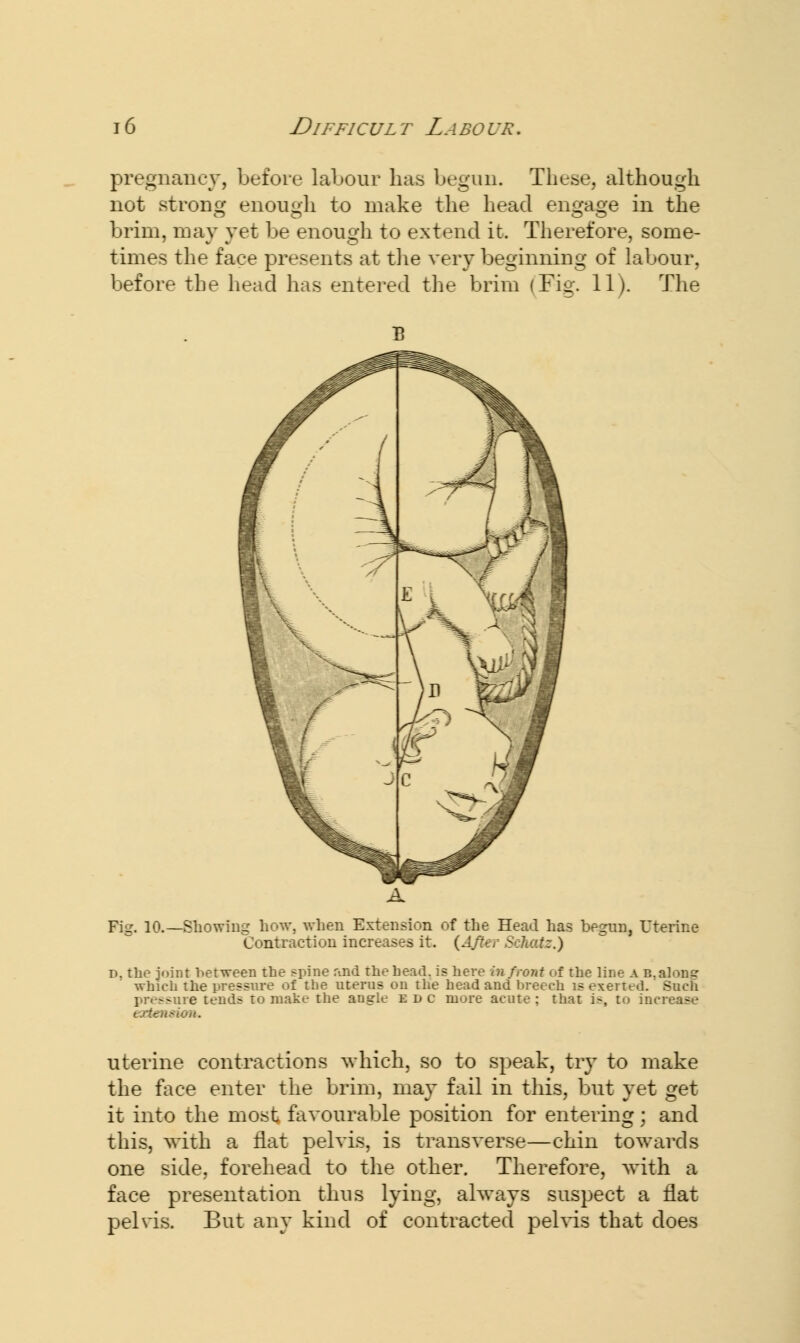 pregnancy, before labour has begun. These, although not strong enough to make the head engage in the brim, may yet he enough to extend it. Therefore, some- times the face presents at the very beginning of labour, before the head has entered the brim (Fig. 11). The Fig. 10.—Showing how, when Extension of the Head has begun, Uterine Contraction increases it. {After Schaiz.) d, the joint between the spine and the head, is here in front of the line A b. alone which the pressure of the uterus on the head and breech is exerted. Such - e tends to make the angle edc more acute; that i>, to increase exta ■ uterine contractions which, so to speak, try to make the face enter the brim, may fail in this, but yet get it into the most favourable position for entering; and this, with a flat pelvis, is transverse—chin towards one side, forehead to the other. Therefore, with a face presentation thus lying, always suspect a flat pelvis. But any kind of contracted pelvis that does