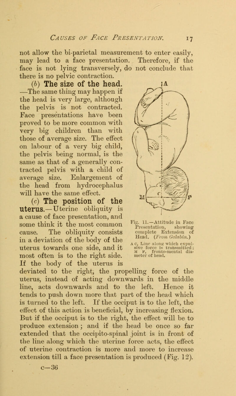 not allow the bi-parietal measurement to enter easily, may lead to a face presentation. Therefore, if the face is not lying transversely, do not conclude that there is no pelvic contraction. (b) The size of the head. —The same thing may happen if the head is very large, although the pelvis is not contracted. Face presentations have been proved to be more common with very big children than with those of average size. The effect on labour of a very big child, the pelvis being normal, is the same as that of a generally con- tracted pelvis with a child of average size. Enlargement of the head from hydrocephalus will have the same effect. (c) The position of the Uterus.—Uterine obliquity is a cause of face presentation, and some think it the most common cause. The obliquity consists in a deviation of the body of the uterus towards one side, and it most often is to the right side. If the body of the uterus is deviated to the right, the propelling force of the uterus, instead of acting downwards in the middle line, acts downwards and to the left. Hence it tends to push down more that part of the head which is turned to the left. If the occiput is to the left, the effect of this action is beneficial, by increasing flexion. But if the occiput is to the right, the effect will be to produce extension ; and if the head be once so far extended that the occipito-spinal joint is in front of the line along which the uterine force acts, the effect of uterine contraction is more and more to increase extension till a face presentation is produced (Fig. 12). c—36 Fig. 11.—Attitude in Face Presentation, showing complete Extension of Head. (From Galabin.) a c, Line along which expul- sive force i> transmitted; M f, fronto-mental dia- meter of head.