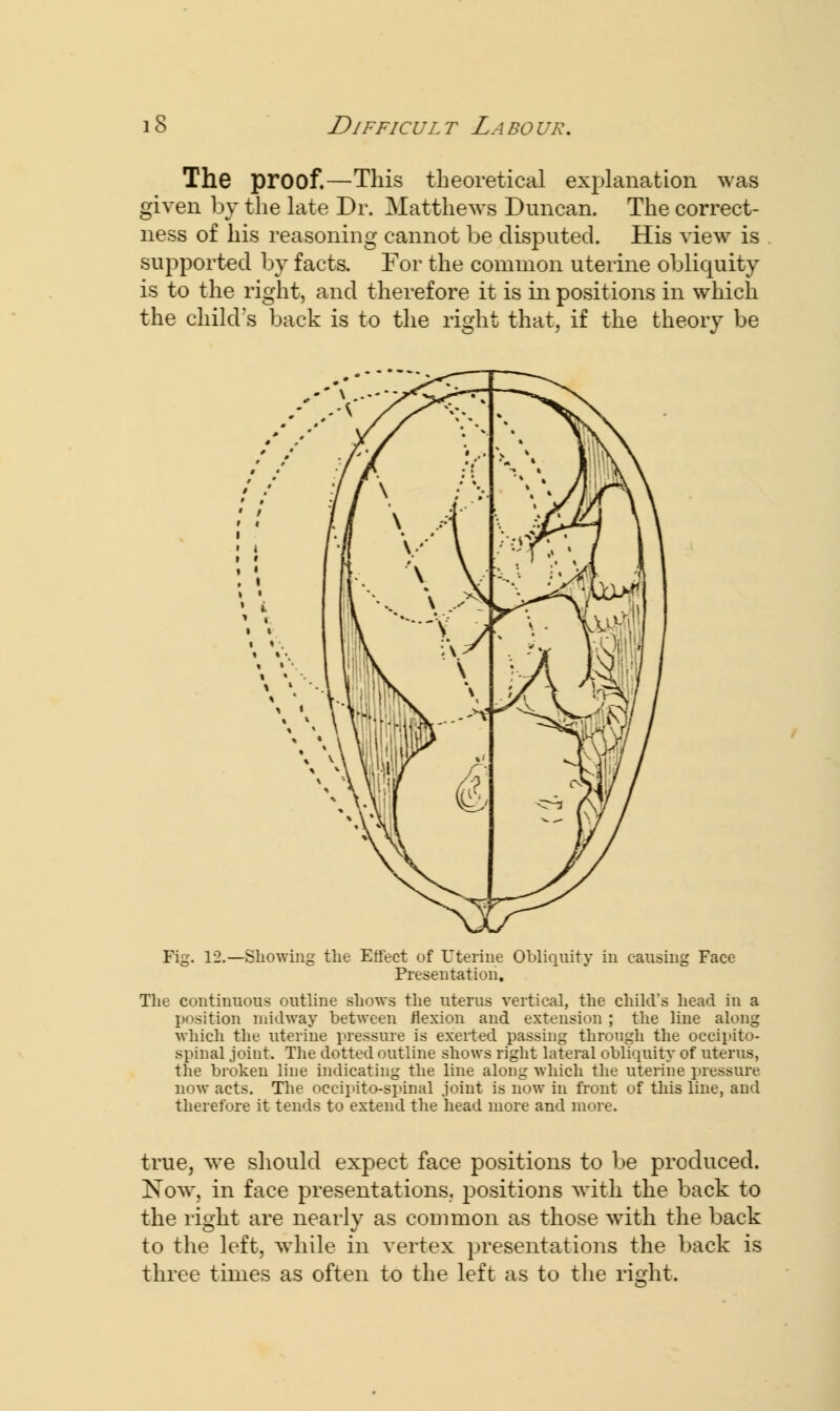 The proof.—This theoretical explanation was given by the late Dr. Matthews Duncan. The correct- ness of his reasoning cannot be disputed. His view is supported by facts. For the common uterine obliquity is to the right, and therefore it is in positions in which the child's back is to the right that, if the theory be Fig. 12.—Showing the Effect of Uterine Obliquity in causing Presentation. Face The continuous outline shows the uterus vertical, the child's head in a position midway between flexion and extension ; the line along which the uterine pressure is exerted passing through the occipito- spinal joint. The dotted outline shows right lateral obliquity of uterus, the broken line indicating the line along which the uterine pressure now acts. The occipito-spinal joint is now in front of this line, and therefore it tends to extend the head more and more. true, w^e should expect face positions to be produced. Now, in face presentations, positions with the back to the right are nearly as common as those with the back to the left, while in vertex presentations the back is three times as often to the left as to the right.