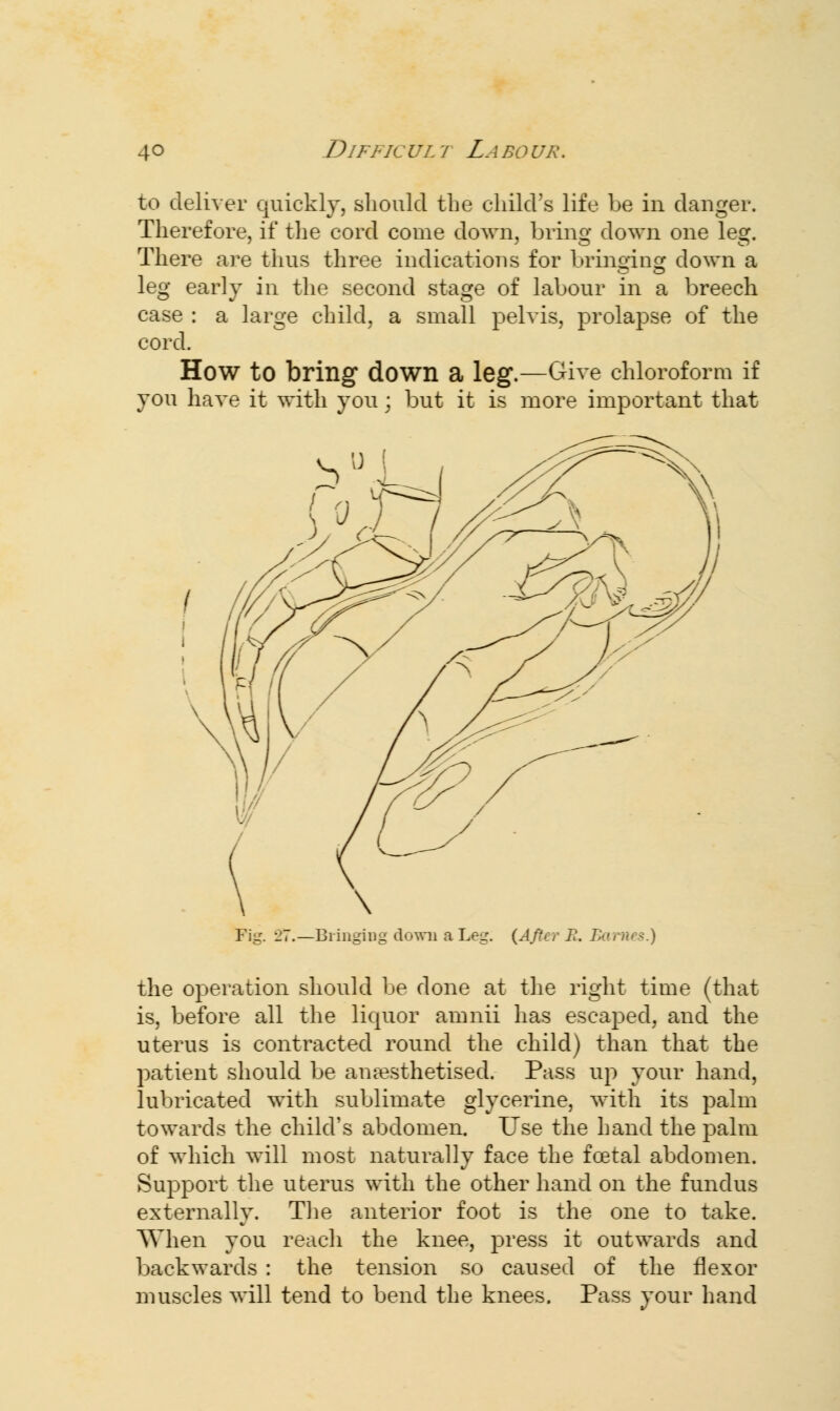 4° DlFFIC UL t La bo ur . to deliver quickly, should the child's life be in danger. Therefore, if the cord come down, bring down one leg. There are thus three indications for bringing down a leg early in the second stage of labour in a breech case : a large child, a small pelvis, prolapse of the cord. How to bring down a leg.—Give chloroform if you have it with you; but it is more important that Pig. -27.—Bringing down a Leg. {After R. Barnes.) the operation should be done at the right time (that is, before all the liquor amnii has escaped, and the uterus is contracted round the child) than that the patient should be anaesthetised. Pass up your hand, lubricated with sublimate glycerine, with its palm towards the child's abdomen. Use the hand the palm of which will most naturally face the foetal abdomen. Support the uterus with the other hand on the fundus externally. The anterior foot is the one to take. When you reach the knee, press it outwards and backwards : the tension so caused of the flexor muscles will tend to bend the knees. Pass your hand