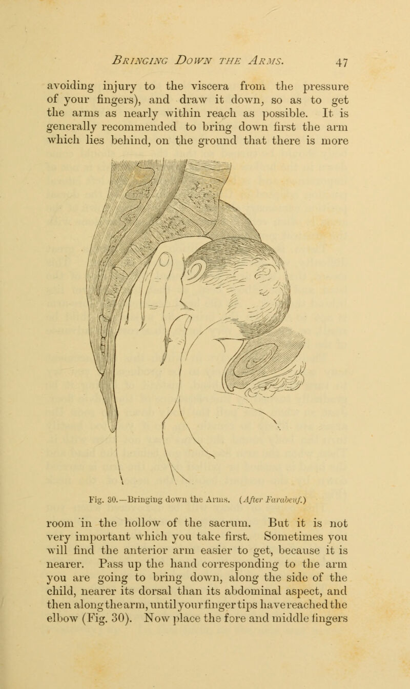 Bringing Down the Arms. avoiding injury to the viscera from the pressure of your fingers), and draw it clown, so as to get the arms as nearly within reach as possible. It is generally recommended to bring down first the arm which lies behind, on the ground that there is more Fig. 30.—Bringing down the Anns. (After Farabeuf.) room in the hollow of the sacrum. But it is not very important which you take first. Sometimes you will find the anterior arm easier to get, because it is nearer. Pass up the hand corresponding to the arm you are going to bring down, along the side of the child, nearer its dorsal than its abdominal aspect, and then along the arm, until your finger tips have reached the elbow (Fig. 30). Now place the fore and middle fingers