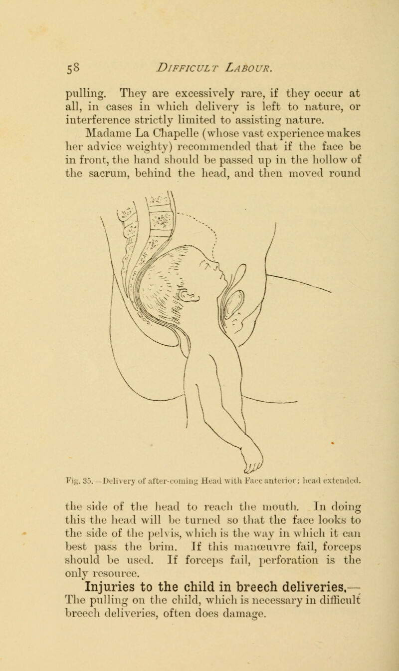 pulling. They are excessively rare, if they occur at all, in cases in which delivery is left to nature, or interference strictly limited to assisting nature. Madame La Chapelle (whose vast experience makes her advice weighty) recommended that if the face be in front, the hand should be passed up in the hollow of the sacrum, behind the head, and then moved round Fig. 35.—Delivery of after-coming Head with Face anterior: head extended. the side of the head to reach the mouth. In doing this the head will be turned so that the face looks to the side of the pelvis, which is the way in which it can best pass the brim. If this manoeuvre fail, forceps should be used. If forceps fail, perforation is the only resource. Injuries to the child in breech deliveries,— The pulling on the child, which is necessary in difficult breech deliveries, often does damage.