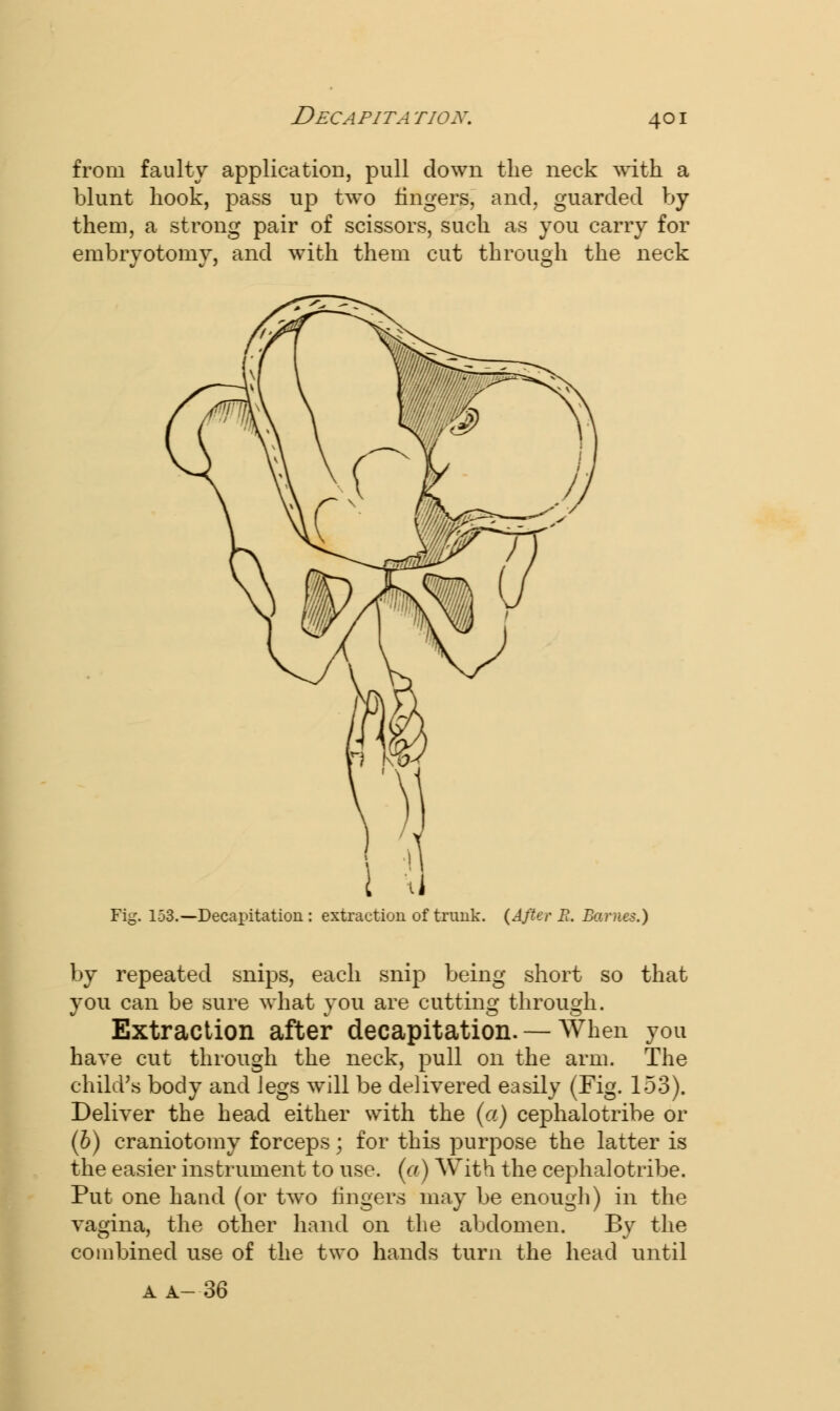 Decapitation. from faulty application, pull down the neck with a blunt hook, pass up two lingers, and, guarded by them, a strong pair of scissors, such as you carry for embryotomy, and with them cut through the neck Fig. 153.—Decapitation : extraction of trunk. (After E. Barnes.) by repeated snips, each snip being short so that you can be sure what you are cutting through. Extraction after decapitation. — When you have cut through the neck, pull on the arm. The child's body and legs will be delivered easily (Fig. 153). Deliver the head either with the (a) cephalotribe or (b) craniotomy forceps; for this purpose the latter is the easier instrument to use. (a) With the cephalotribe. Put one hand (or two lingers may be enough) in the vagina, the other hand on the abdomen. By the combined use of the two hands turn the head until A A- 36