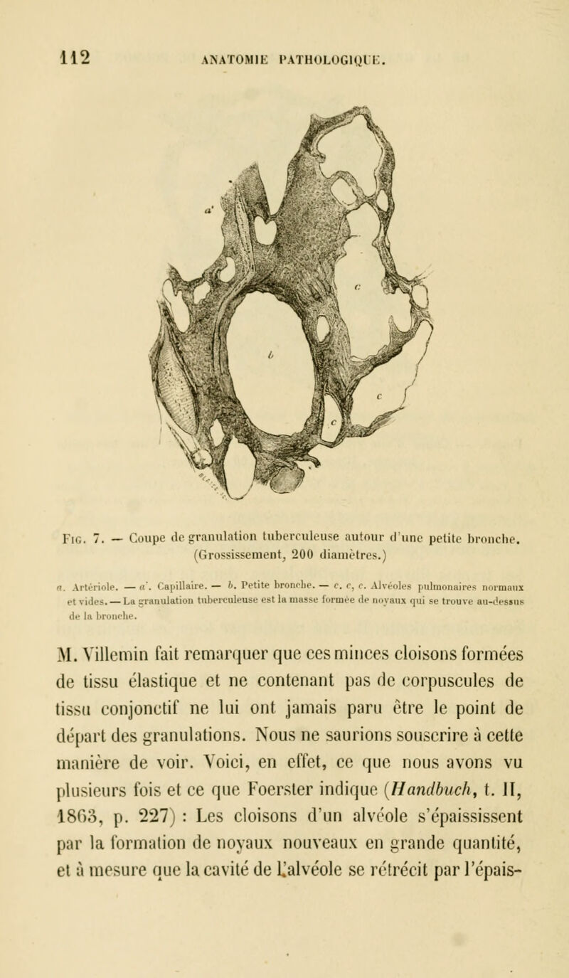 lu;. 7. — Coupe de granulation tuberculeuse autour d'une petite bronche. (Grossissement, 200 diamètres.) . Artériole. —a*. Capillaire.— 6. Petite bronche. — c. c, c. Alvéoles pulmonaires normaux et vides. — La granulation tuberculeuse est la niasse formée de noyaux qui se trouve au-dessus de la bronche. M. Yillcmin fait remarquer que ces minces cloisons formées de tissu élastique et ne contenant pas de corpuscules de tissu conjonctif ne lui ont jamais paru être le point de départ des granulations. Nous ne saurions souscrire à cette manière de voir. Voici, en effet, ce que nous avons vu plusieurs fois et ce que Focrsler indique (Handbuch, t. II, 1803, p. 227) : Les cloisons d'un alvéole s'épaississent par la formation de noyaux nouveaux en grande quantité, et à mesure que la cavité de ^alvéole se rétrécit par l'épais-