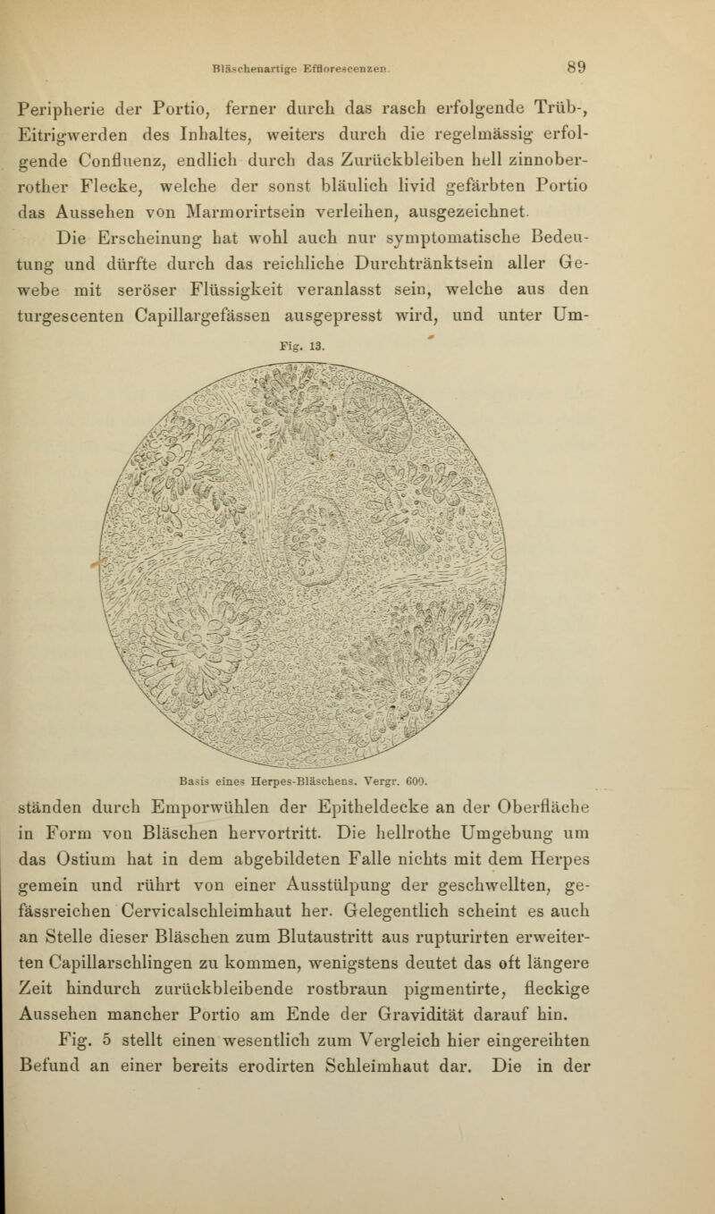 Peripherie der Portio, ferner durch das rasch erfolgende Trüb-, Eitrigwerden des Inhaltes, weiters durch die regelmässig- erfol- gende Confluenz, endlich durch das Zurückbleiben hell zinnober- rother Flecke, welche der sonst bläulich livid gefärbten Portio das Aussehen von Marinorirtsein verleihen, ausgezeichnet. Die Erscheinung hat wohl auch nur symptomatische Bedeu- tung und dürfte durch das reichliche Durchtränktsein aller Ge- webe mit seröser Flüssigkeit veranlasst sein, welche aus den turgescenten Capillargefässen ausgepresst wird, und unter Um- Fig. 13. Basis eine? Herpes-Bläschens. Vergr. 600. ständen durch Emporwühlen der Epitheldecke an der Oberfläche in Form von Bläschen hervortritt. Die hellrothe Umgebung um das Ostium hat in dem abgebildeten Falle nichts mit dem Herpes gemein und rührt von einer Ausstülpung der geschwellten, ge- fässreichen Cervicalschleimhaut her. Gelegentlich scheint es auch an Stelle dieser Bläschen zum Blutaustritt aus rupturirten erweiter- ten Capillarschlingen zu kommen, wenigstens deutet das oft längere Zeit hindurch zurückbleibende rostbraun pigmentirte, fleckige Aussehen mancher Portio am Ende der Gravidität darauf hin. Fig. 5 stellt einen wesentlich zum Vergleich hier eingereihten Befund an einer bereits erodirten Schleimhaut dar. Die in der