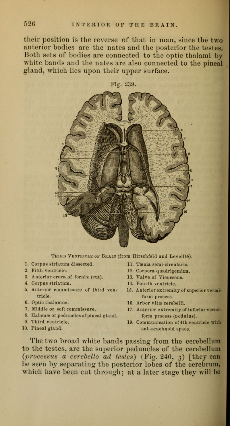 52G their position is the reverse of that in man, since the two anterior bodies are the nates and the posterior the testes. Both sets of bodies are connected to the optic thalami by white bands and the nates are also connected to the pineal gland, which lies upon their upper surface. Third Ventricle of Brain 1. Corpus striatum dissected. 2. Fifth ventricle. 3. Anterior crura of fornix (cut). 4. Corpus striatum. 5. Anterior commissure of third ven- tricle. 6. Optic thalamus. 7. Middle or soft commissure. S. Hahenaj or peduncles of pineal gland 9. Third ventricle. 10. Pineal gland. (from Hirschfeld and Leveillg). 11. Taenia semi-circularis. 12. Corpora quadrigemina. 13. Valve of Vieussens. 14. Fourth ventricle. Anterior extremity of superior vermi- form process. Arhor vita; cerehelli. Anterior extremity of inferior vermi- form process (nodulus). Communication of 4th ventricle with suh-arachnoid space. 13. 19. The two broad white bands passing from the cerebellum to the testes, are the superior peduncles of the cerebellum {processus a cerebello ad testes) (Fig. 240, 3) [they can be seen by separating the posterior lobes of the cerebrum, which have been cut through; at a later stage they will be