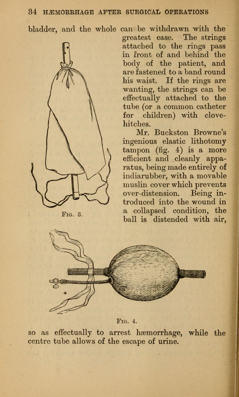 bladder, and the whole can be withdrawn with the Fig. greatest ease. The strings attached to the rings pass in front of and behind the body of the patient, and are fastened to a band round his waist. If the rings are wanting, the strings can be effectually attached to the tube (or a common catheter for children) with clove- hitches. Mr. Buckston Browne's ingenious elastic lithotomy tampon (fig. 4) is a more efficient and cleanly appa- ratus, being made entirely of indiarubber, with a movable muslin cover which prevents over-distension. Being in- troduced into the wound in a collapsed condition, the ball is distended with air. Fig. 4. so as effectually to arrest haemorrhage, while the centre tube allows of the escape of urine.