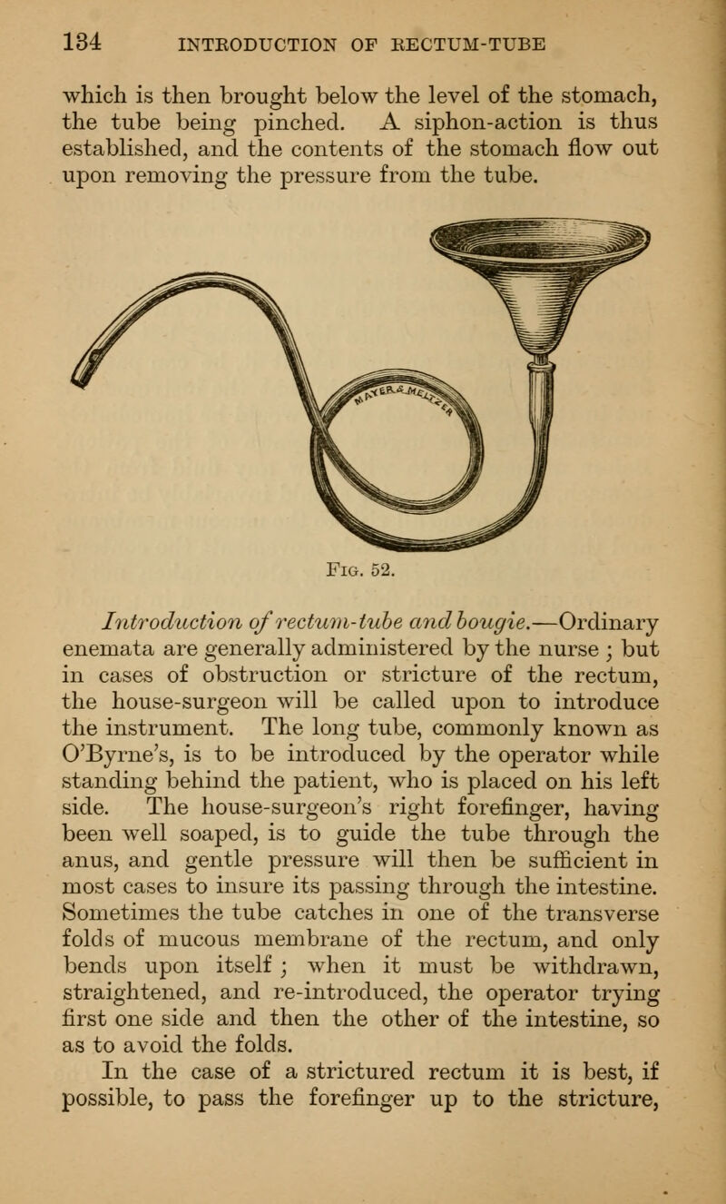 which is then brought below the level of the stomach, the tube being pinched. A siphon-action is thus established, and the contents of the stomach flow out upon removing the pressure from the tube. Fig. 52. Introduction of rectum-tube andhougie.—Ordinary enemata are generally administered by the nurse ; but in cases of obstruction or stricture of the rectum, the house-surgeon will be called upon to introduce the instrument. The long tube, commonly known as O'Byrne's, is to be introduced by the operator while standing behind the patient, who is placed on his left side. The house-surgeon's right forefinger, having been well soaped, is to guide the tube through the anus, and gentle pressure will then be sufficient in most cases to insure its passing through the intestine. Sometimes the tube catches in one of the transverse folds of mucous membrane of the rectum, and only bends upon itself ; when it must be withdrawn, straightened, and re-introduced, the operator trying first one side and then the other of the intestine, so as to avoid the folds. In the case of a strictured rectum it is best, if possible, to pass the forefinger up to the stricture,