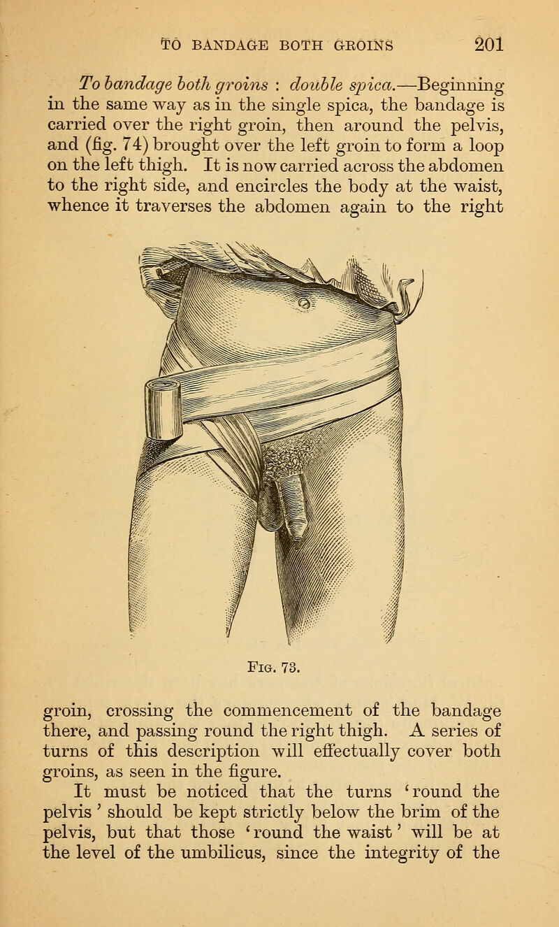 To bandage both groins : double spica.—Beginning in the same way as in the single spica, the bandage is carried over the right groin, then around the pelvis, and (fig. 74) brought over the left groin to form a loop on the left thigh. It is now carried across the abdomen to the right side, and encircles the body at the waist, whence it traverses the abdomen again to the right Fig. 73. groin, crossing the commencement of the bandage there, and passing round the right thigh. A series of turns of this description will effectually cover both groins, as seen in the figure. It must be noticed that the turns 'round the pelvis ' should be kept strictly below the brim of the pelvis, but that those ' round the waist' will be at the level of the umbilicus, since the integrity of the