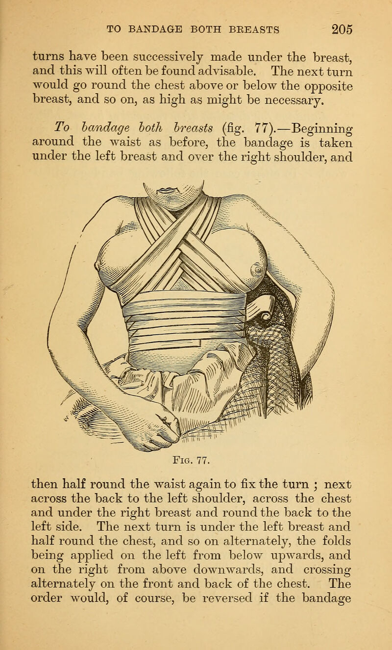 turns have been successively made under the breast, and this will often be found advisable. The next turn would go round the chest above or below the opposite breast, and so on, as high as might be necessary. To handage hoth breasts (fig. 77).—Beginning around the waist as before, the bandage is taken under the left breast and over the right shoulder, and then half round the waist again to fix the turn ; next across the back to the left shoulder, across the chest and under the right breast and round the back to the left side. The next turn is under the left breast and half round the chest, and so on alternately, the folds being applied on the left from below upwards, and on the right from above downwards, and crossing alternately on the front and back of the chest. The order would, of course, be reversed if the bandage