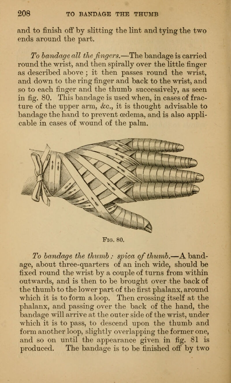 and to finish off by slitting the lint and tying the two ends around the part. To bandage all the fingers.—The bandage is carried round the wrist, and then spirally over the little finger as described above ; it then passes round the wrist, and down to the ring finger and back to the wrist, and so to each finger and the thumb successively, as seen in fig. 80. This bandage is used when, in cases of frac- ture of the upper arm, <fec., it is thought ad\dsable to bandage the hand to prevent oedema, and is also appli- cable in cases of wound of the palm. Fm. 80. To bandage the thumb : spica of thiimb.—A band- age, about three-quarters of an inch wide, should be fixed round the wrist by a couple of turns from within outwards, and is then to be brought over the back of the thumb to the lower part of the first phalanx, around which it is to form a loop. Then crossing itself at the phalanx, and passing over the back of the hand, the bandage will arrive at the outer side of the wrist, under which it is to pass, to descend upon the thumb and form another loop, slightly overlapping the former one, and so on until the appearance given in fig. 81 is produced. The bandage is to be finished off by two