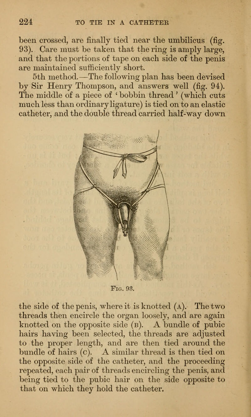 been crossed, are finally tied near the umbilicus (fig. 93). Care must be taken that the ring is amply large, and that the portions of tape on each side of the penis are maintained sufficiently short. 5th method.—The following plan has been devised by Sir Henry Thompson, and answers well (fig. 94). The middle of a piece of ' bobbin thread' (which cuts much less than ordinary ligature) is tied on to an elastic catheter, and the double thread carried half-way down Fig. 93. the side of the penis, where it is knotted (a). The two threads then encircle the organ loosely, and are again knotted on the opposite side (b). A bundle of pubic hairs having been selected, the threads are adjusted to the proper length, and are then tied around the bundle of hairs (c). A similar thread is then tied on the opposite side of the catheter, and the proceeding repeated, each pair of threads encircling the penis, and being tied to the pubic hair on the side opposite to that on which they hold the catheter.