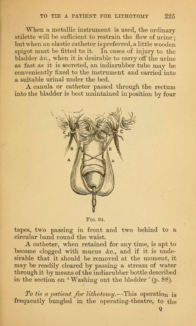 When a metallic instrument is used, the ordinary stilette will be sufficient to restrain the flow of urine; but when an elastic catheter is preferred, a little wooden spigot must be fitted to it. In cases of injury to the bladder itc, when it is desirable to carry off the urine as fast as it is secreted, an indiarubber tube may be conveniently fixed to the instrument and carried into a suitable urinal under the bed. A canula or catheter passed through the rectum into the bladder is best maintained in position by four ^Uj^ Fig. 94. tapes, two passing in front and two behind to a circular band round the waist. A catheter, when retained for any time, is apt to become clogged with mucus &c., and if it is unde- sirable that it should be removed at the moment, it may be readily cleared by passing a stream of water through it by means of the indiarubber bottle described in the section on ' Washing out the bladder ' (p. 88). To tie a loatient for lithotomy.—This operation is frequently bungled in the operating-theatre, to the Q