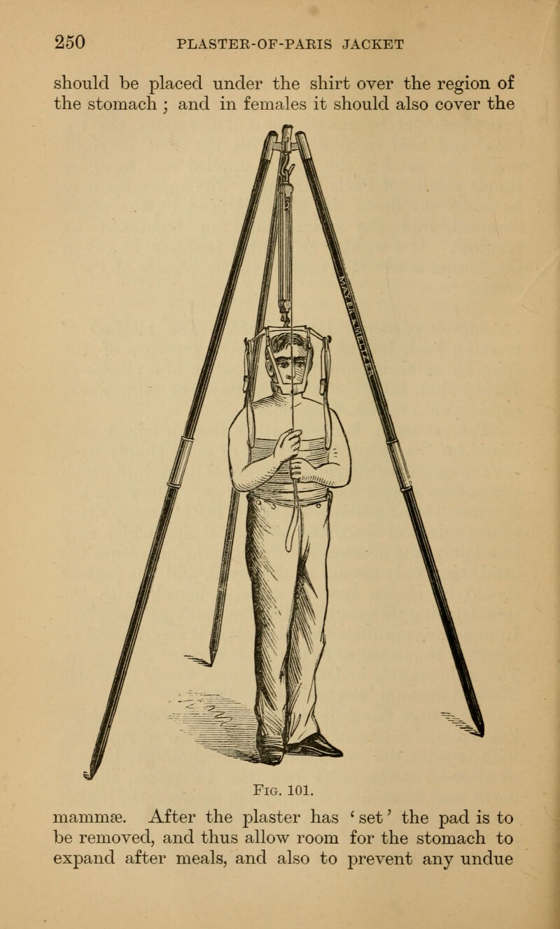 should be placed under the shirt over the region of the stomach ; and in females it should also cover the Fig. 101. mammse. After the plaster has ' set' the pad is to be removed, and thus allow room for the stomach to expand after meals, and also to j)revent any undue