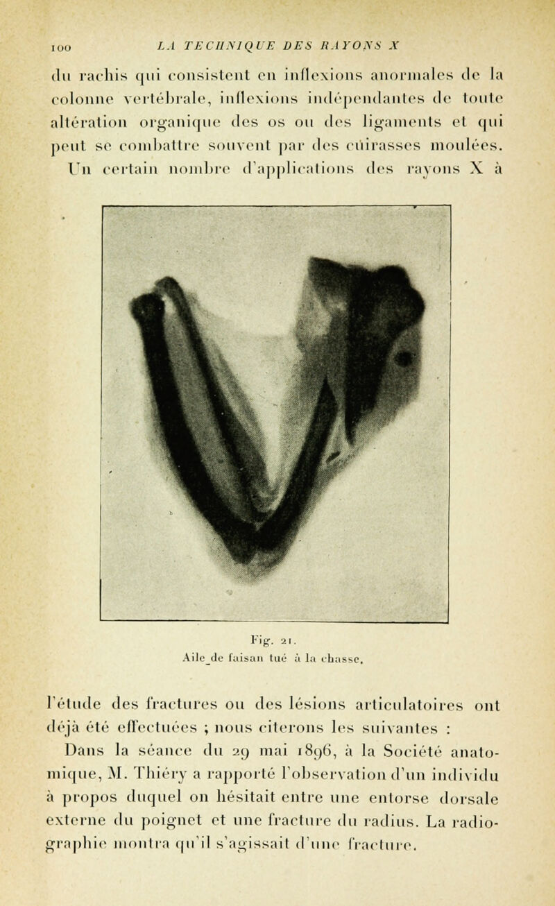 du rachis qui consistent en inflexions anormales de la colonne vertébrale, inflexions indépendantes de toute altération organique des os ou des ligaments et qui peut se combattre souvent par des cuirasses moulées. Un certain nombre d'applications des l'ayons X à V'\g. 21. Aile do faisan tué à la chasse. l'élude des fractures ou des lésions articulatoires ont déjà été effectuées ; nous citerons les suivantes : Dans la séance du 29 mai 1896, à la Société anato- mique, M. Thiéry a rapporté l'observation d'un individu à propos duquel on hésitait entre une entorse dorsale externe du poignet et une fracture du radius. La radio- graphie montra qu'il s'agissait d'une fracture,