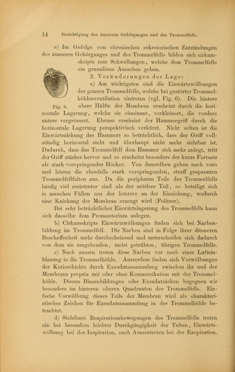 e) Im Gefolge von chronischen sekretorischen Entzündungen des äusseren Gehörganges und des Trommelfells bilden sich cirkum- skripte rote Schwellungen, welche dem Trommelfelle ein granulöses Aussehen geben. 2. Veränderungen der Lage: a) Am wichtigsten sind die Einwärtswölbungen des ganzen Trommelfells, welche bei gestörter Trommel- höhlenventilation eintreten (vgl. Fig. 6). Die hintere Fig. 6. obere Hälfte der Membran erscheint durch die hori- zontale Lagerung, welche sie einnimmt, verkleinert, die vordere untere vergrössert. Ebenso erscheint der Hammergriff durch die horizontale Lagerung perspektivisch verkürzt. Nicht selten ist die Einwärtsziehung des Hammers so beträchtlich, dass der Griff voll- ständig horizontal steht und überhaupt nicht mehr sichtbar ist. Dadurch, dass das Trommelfell dem Hammer sich mehr anlegt, tritt der Griff stärker hervor und es erscheint besonders der kurze Fortsatz als stark vorspringender Höcker. Von demselben gehen nach vorn und hinten die ebenfalls stark vorspringenden, straff gespannten Trommelfellfalten aus. Da die peripheren Teile des Trommelfells häufig viel resistenter sind als der mittlere Teil, so beteiligt sich in manchen Fällen nur der letztere an der Einziehung, wodurch eine Knickung der Membran erzeugt wird (Politzer). Bei sehr beträchtlicher Einwärtslagerung des Trommelfells kann sich dasselbe dem Promontorium anlegen. b) Cirkumskripte Einwärtswölbungen finden sich bei Narben- bildung im Trommelfell. Die Narben sind in Folge ihrer dünneren Beschaffenheit mehr durchscheinend und unterscheiden sich dadurch von dem sie umgebenden, meist getrübten, übrigen Trommelfelle. c) Nach aussen treten diese Narben vor nach einer Luftein- blasung in die Trommelhöhle. Ausserdem linden sich Vorwölbungen der Kutisschichte durch Exsudatansammlung zwischen ihr und der Membrana propria mit oder ohne Kommunikation mit der Trommel- höhle. Diesen Blasenbildungen oder Exsudatsäcken begegnen wir besonders im hinteren oberen Quadranten des Trommelfells. Ein- fache Vorwölbung dieses Teils der Membran wird als charakteri- stisches Zeichen für Exsudatansammlung in der Trommelhöhle be- trachtet. d) Sichtbare Respirationsbewegungen des Trommelfells treten ein bei besonders leichter Durchgängigkeit der Tuben, Einwärts- wölbung bei der Inspiration, nach Ausscntreten bei der Exspiration.