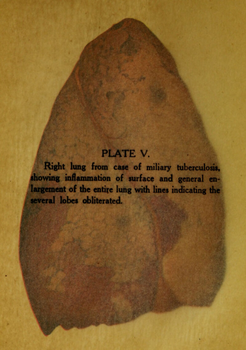 PLATE V. Right lung from ca«e of miliary tuberculosis, showing inflammation of surface and general en- largement of the entire lung with lines indicating the several lobes obliterated.