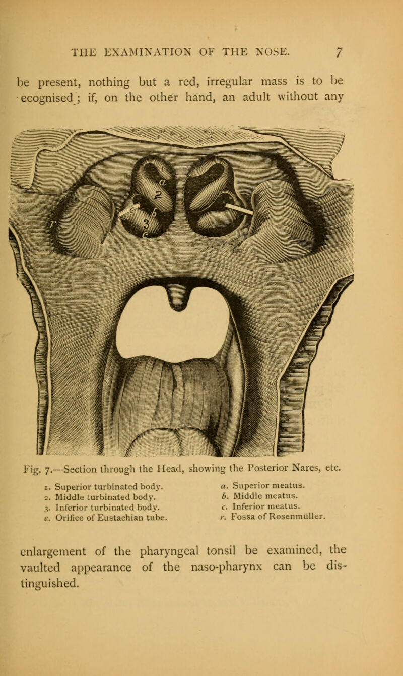 be present, nothing but a red, irregular mass is to be ecognised j if, on the other hand, an adult without any Fig. 7.—Section through the Head, showing the Tosterior Nares, etc. 1. Superior turbinated body. z. Middle turbinated body. 3. Inferior turbinated body. c. Orifice of Eustachian tube. a. Superior meatus. b. Middle meatus. c. Inferior meatus. r. Fossa of Rosennnillui enlargement of the pharyngeal tonsil be examined, the vaulted appearance of the naso-pharynx can be dis- tinguished.