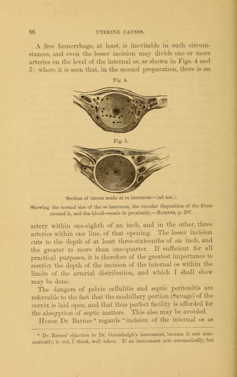 A free hemorrhage, at least, is inevitable in such circum- stances, and even the lesser incision may divide one or more arteries on the level of the internal os. as shown in Figs. -4 and 5; where it is seen that, in the second preparation, there is an Fi-. 4. Fiff. 5. Section of uterus made at os internum— ad nat.). Showing the normal size of the os internum, the circular disposition of the fibres around it, and the Llood-vessek in proximity.—Bab>-es, p. 207. arterv within one-eighth of an inch, and in the other, three aiteries within one line, of that opening. The lesser incision cuts to the depth of at least three-sixteenths of an inch, and the greater to more than one-quaiter. If sufficient for all practical purposes, it is therefore of the greatest importance to restrict the depth of the incision of the internal os within the limits of the arterial distribution, and which I shall show may be done. The dangers of pelvic cellulitis and septic peritonitis are referrable to the fact that the medullary portion (Savage) of the cervix is laid open, and that thus perfect facility is afforded for the absorption of septic matters. This also may be avoided. Hence Dr. Barnes =*= regards  incision of the internal os as Dr. Barnes' objection to Dr. Greenhalgh's instrument, because it acts auto- matically, is not. I think, well taken. If an instrument acts automatically, but