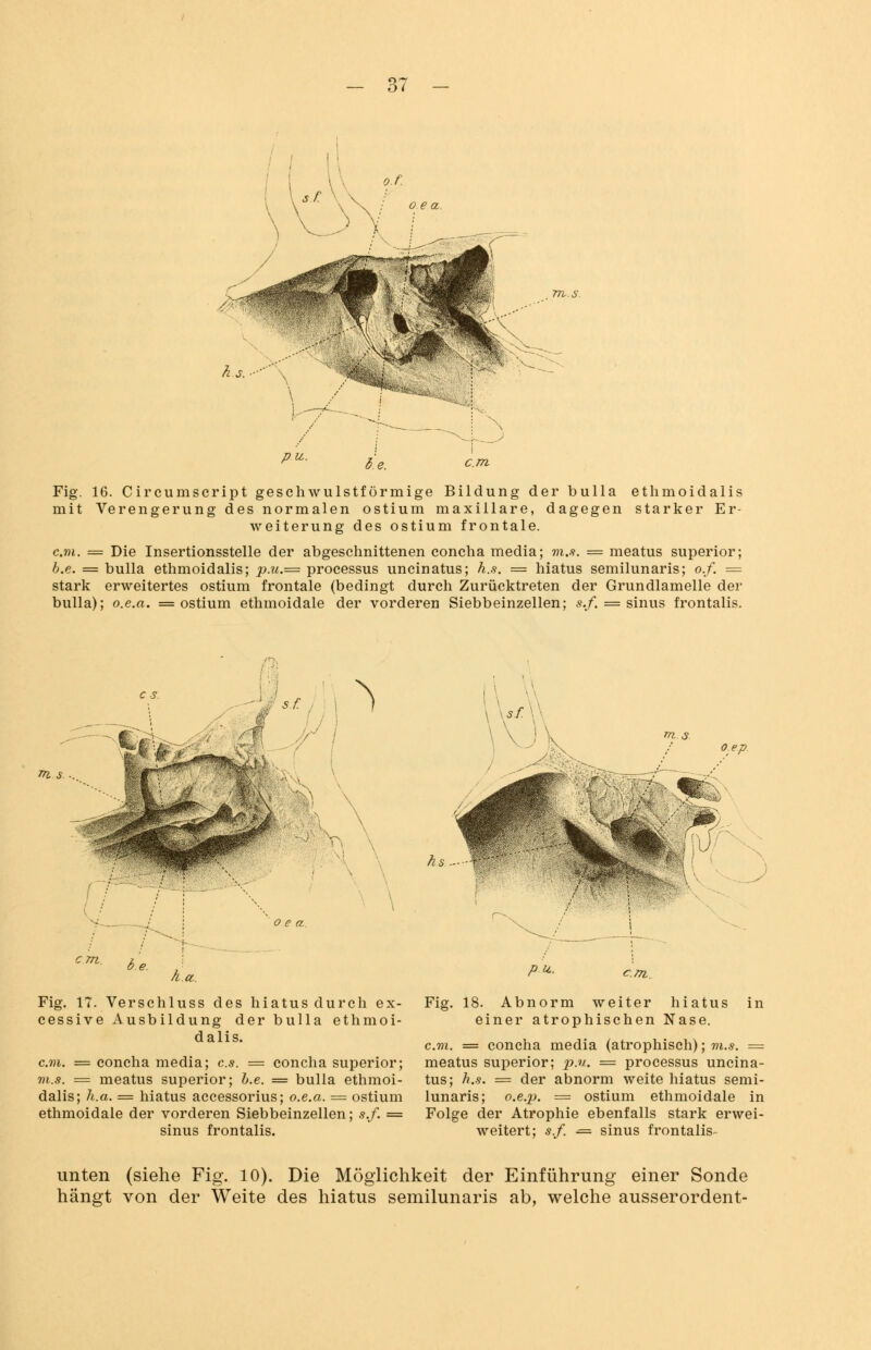 p.u. b.e. Fig. 16. Circumscript geschwulstförmige Bildung der bulla ethmoidalis mit Verengerung des normalen ostium maxillare, dagegen starker Er- weiterung des ostium frontale. c.m. = Die Insertionsstelle der abgeschnittenen concha media; m.s. = meatus superior; b.e. = bulla ethmoidalis; p.u.= processus uncinatus; h.s. = hiatus semilunaris; o.f. = stark erweitertes ostium frontale (bedingt durch Zurücktreten der Grundlamelle der bulla); o.e.a. = ostium ethmoidale der vorderen Siebbeinzellen; s.f. = sinus frontalis. m. s. Lyn Fig. 17. Verschluss des hiatus durch ex- cessive Ausbildung der bulla ethmoi- dalis. c.m. — concha media; es. = concha superior; m.s. = meatus superior; b.e. = bulla ethmoi- dalis; h.a. = hiatus accessorius; o.e.a. = ostium ethmoidale der vorderen Siebbeinzellen; *./. = sinus frontalis. pu. cm. in Fig. 18. Abnorm weiter hiatus einer atrophischen Nase. c.m. = concha media (atrophisch); m.s. = meatus superior; p.u. = processus uncina- tus; h.s. = der abnorm weite hiatus semi- lunaris; o.e.p. = ostium ethmoidale in Folge der Atrophie ebenfalls stark erwei- weitert; s.f. = sinus frontalis- unten (siehe Fig. 10). Die Möglichkeit der Einführung einer Sonde hängt von der Weite des hiatus semilunaris ab, welche ausserordent-