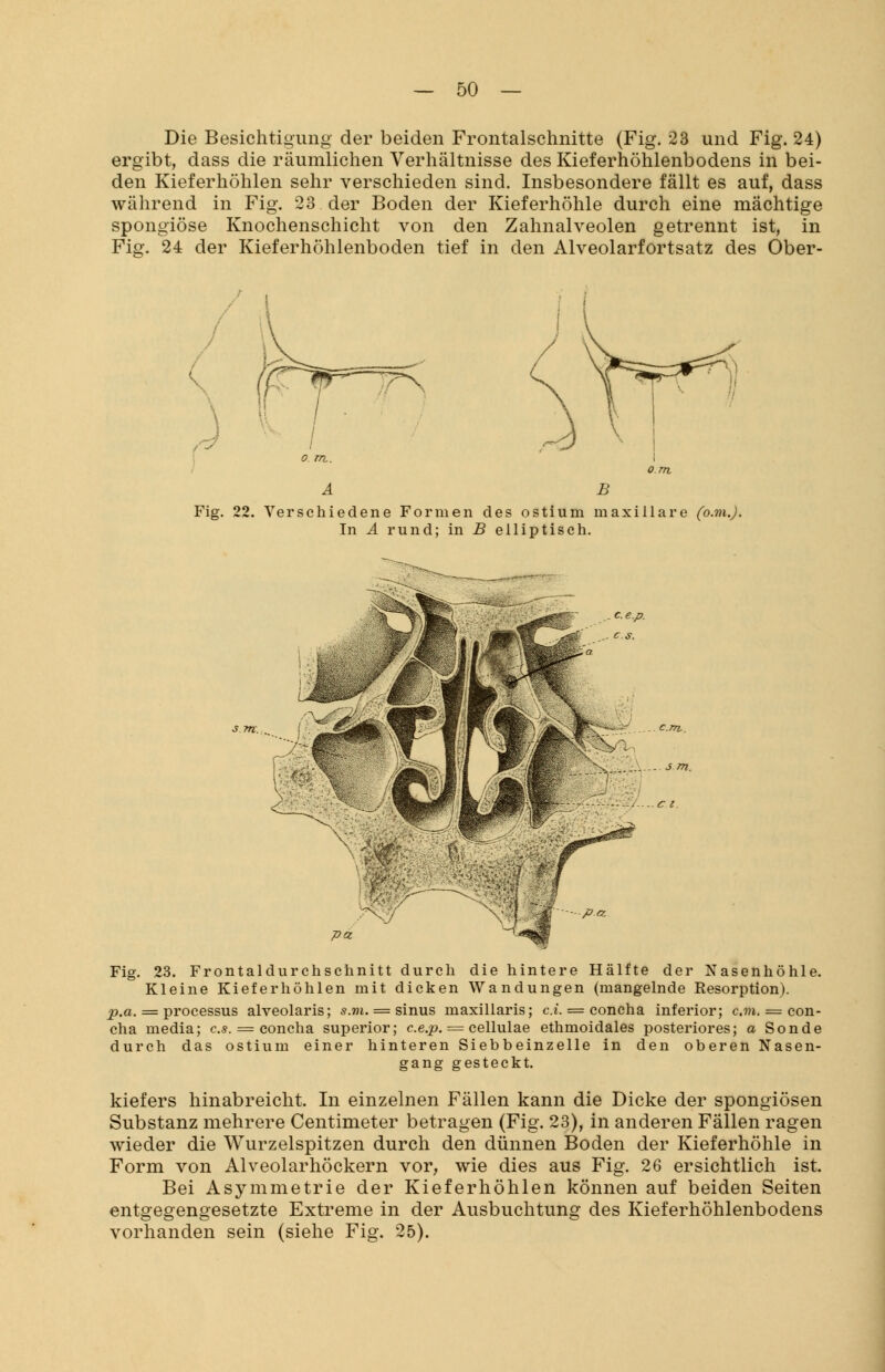 Die Besichtigung der beiden Frontalschnitte (Fig. 23 und Fig. 24) ergibt, dass die räumlichen Verhältnisse des Kieferhöhlenbodens in bei- den Kieferhöhlen sehr verschieden sind. Insbesondere fällt es auf, dass während in Fig. 23 der Boden der Kieferhöhle durch eine mächtige spongiöse Knochenschicht von den Zahnalveolen getrennt ist, in Fig. 24 der Kieferhöhlenboden tief in den Alveolarfortsatz des Ober- A B Fig. 22. Verschiedene Formen des ostium maxillare (o.m.J. In A rund; in B elliptisch. Fig. 23. Frontaldurchschnitt durch die hintere Hälfte der Nasenhöhle. Kleine Kieferhöhlen mit dicken Wandungen (mangelnde Resorption). p,a. = processus alveolaris; s.m. = sinus maxillaris; c.i. = concha inferior; cm. = con- cha media; es. = concha superior; c.e.p. = eellulae ethmoidales posteriores; a Sonde durch das ostium einer hinteren Siebbeinzelle in den oberen Nasen- gang gesteckt. kiefers hinabreicht. In einzelnen Fällen kann die Dicke der spongiösen Substanz mehrere Centimeter betragen (Fig. 23), in anderen Fällen ragen wieder die Wurzelspitzen durch den dünnen Boden der Kieferhöhle in Form von Alveolarhöckern vor, wie dies aus Fig. 26 ersichtlich ist. Bei Asymmetrie der Kieferhöhlen können auf beiden Seiten entgegengesetzte Extreme in der Ausbuchtung des Kieferhöhlenbodens vorhanden sein (siehe Fig. 25).