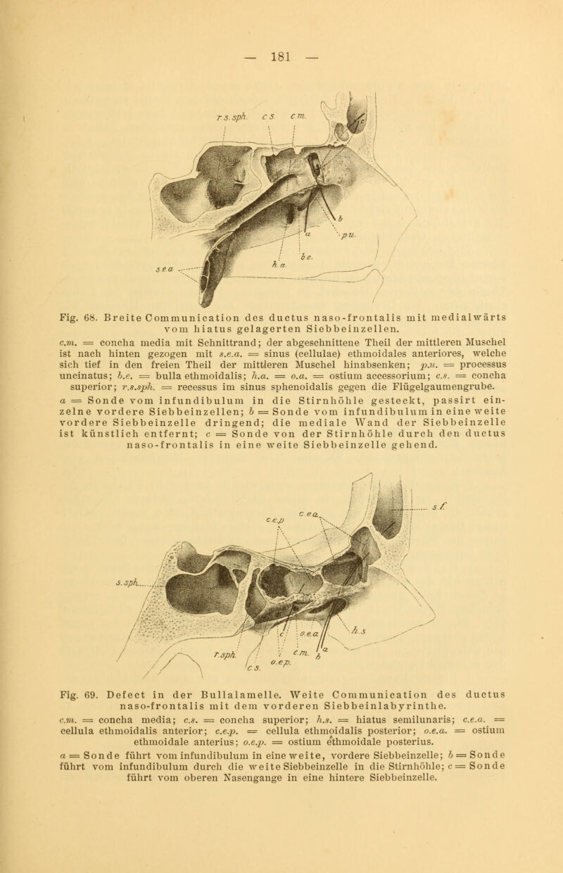 Fig. 68. Breite Communication des ductus naso-frontalis mit medialwärts vom hiatus gelagerten Siebbeinzellen. c.m. = conclia media mit Schnittrand; der abgeschnittene Theil der mittleren Muschel ist nach hinten gezogen mit s.e.a. = sinus (cellulae) ethmoidales anteriores, welche sich tief in den freien Theil der mittleren Muschel hinabsenken; p.u. = Processus uncinatus; b.e. = bulla ethmoidalis; h.a. = o.a. = ostium accessorium; es. = concha superior; r.s.sph. = recessus im sinus sphenoidalis gegen die Flügelgaumengrube. a = Sonde vom infundibulum in die Stirnhöhle gesteckt, passirt ein- zelne vordere Siebbeinzellen; b = Sonde vom infundibulum in eine weite vordere Siebbeinzelle dringend; die mediale Wand der Siebbeinzelle ist künstlich entfernt; c = Sonde von der Stirnhöhle durch den ductus naso-frontalis in eine weite Siebbeinzelle gehend. c e.p s.sph /M 'es. •'<* Fig. 69. Defect in der Bullalamelle. Weite Communication des ductus naso-frontalis mit dem vorderen Siebbeinlabyrinthe. cm. = concha media; es. = concha superior; h.s. = hiatus semilunaris; c.e.a. = cellula ethmoidalis anterior; c.e.p. = cellula ethmoidalis posterior; o.e.a. = ostium ethmoidale anterius; o.e.p. = ostium e'thmoidale posterius. « = Sonde führt vom infundibulum in eine weite, vordere Siebbeinzelle; 6 = Sonde führt vom infundibulum durch die weite Siebbeinzelle in die Stirnhöhle; c = Sonde führt vom oberen Nasengange in eine hintere Siebbeinzelle.