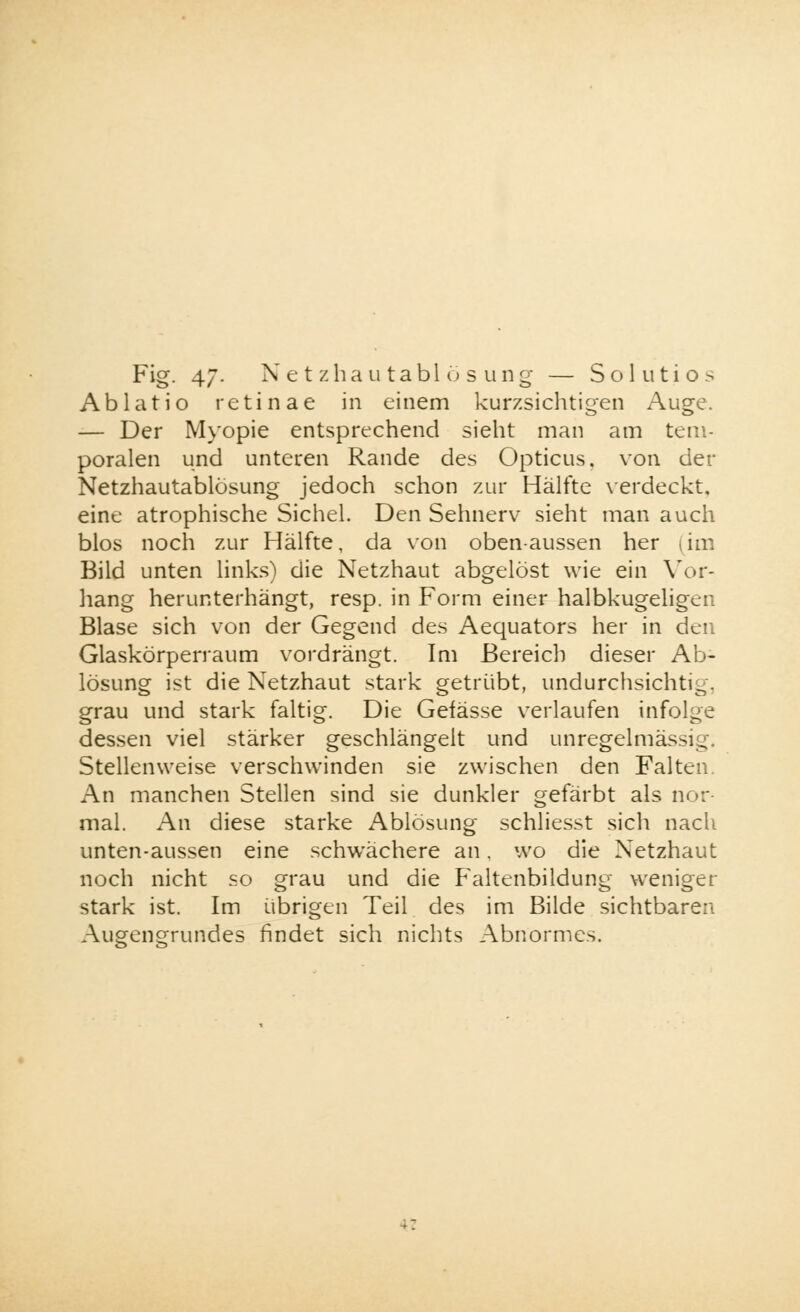 Ablatio retinae in einem kurzsichtigen Auge. — Der Myopie entsprechend sieht man am tem- poralen und unteren Rande des Opticus, von der Netzhautablösung jedoch schon zur Hälfte verdeckt, eine atrophische Sichel. Den Sehnerv sieht man auch blos noch zur Hälfte, da von oben-aussen her (im Bild unten links) die Netzhaut abgelöst wie ein Vor- hang herunterhängt, resp. in Form einer halbkugeligen Blase sich von der Gegend des Aequators her in den Glaskörperraum vordrängt. Im Bereich dieser Ab- lösung ist die Netzhaut stark getrübt, undurchsichtig, grau und stark faltig. Die Gefässe verlaufen infolge dessen viel stärker geschlängelt und unregelmässig Stellenweise verschwinden sie zwischen den Falten. An manchen Stellen sind sie dunkler gefärbt als nor- mal. An diese starke Ablösung schliesst sich nach unten-aussen eine schwächere an. wo die Netzhaut noch nicht so grau und die Faltenbildung weniger stark ist. Im übrigen Teil des im Bilde sichtbaren Augengrundes findet sich nichts Abnormes.