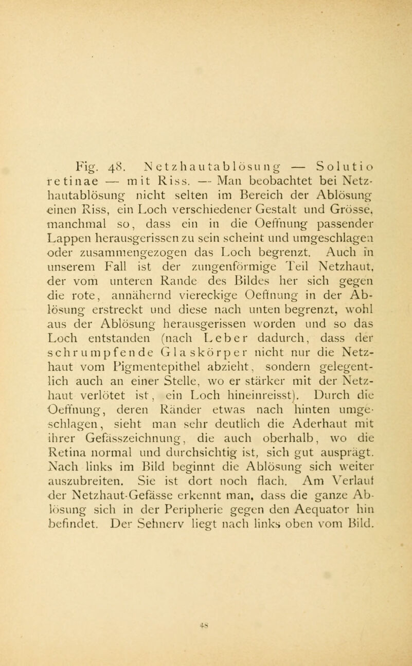 Fig. 48. Netzhautablösung — So 1 utio retinae — mit Riss. — Man beobachtet bei Netz- hautablösuno- nicht selten im Bereich der Ablösung1 einen Riss, ein Loch verschiedener Gestalt und Grösse» manchmal so, dass ein in die Oeffnung passender Lappen herausgerissen zu sein scheint und umgeschlagen oder zusammengezogen das Loch begrenzt. Auch in unserem Fall ist der zungenförmige Teil Netzhaut, der vom unteren Rande des Bildes her sich gegen die rote, annähernd viereckige Oeffnung in der Ab- lösung erstreckt und diese nach unten begrenzt, wohl aus der Ablösung herausgerissen worden und so das Loch entstanden (nach Leber dadurch, dass der schrumpfende Glaskörper nicht nur die Netz- haut vom Pigmentepithel abzieht, sondern gelegent- lich auch an einer Stelle, wo er stärker mit der Netz- haut verlötet ist, ein Loch hineinreisst). Durch die Oeffnung, deren Ränder etwas nach hinten umge- schlagen, sieht man sehr deutlich die Aderhaut mit ihrer Gefasszeichnung, die auch oberhalb, wo die Retina normal und durchsichtig ist, sich gut ausprägt. Nach links im Bild beginnt die Ablösung sich weiter auszubreiten. Sie ist dort noch flach. Am Verlauf der Netzhaut-Gefässe erkennt man, dass die ganze Ab- lösung sich in der Peripherie gegen den Aequator hin befindet. Der Sehnerv liegt nach links oben vom Bild.