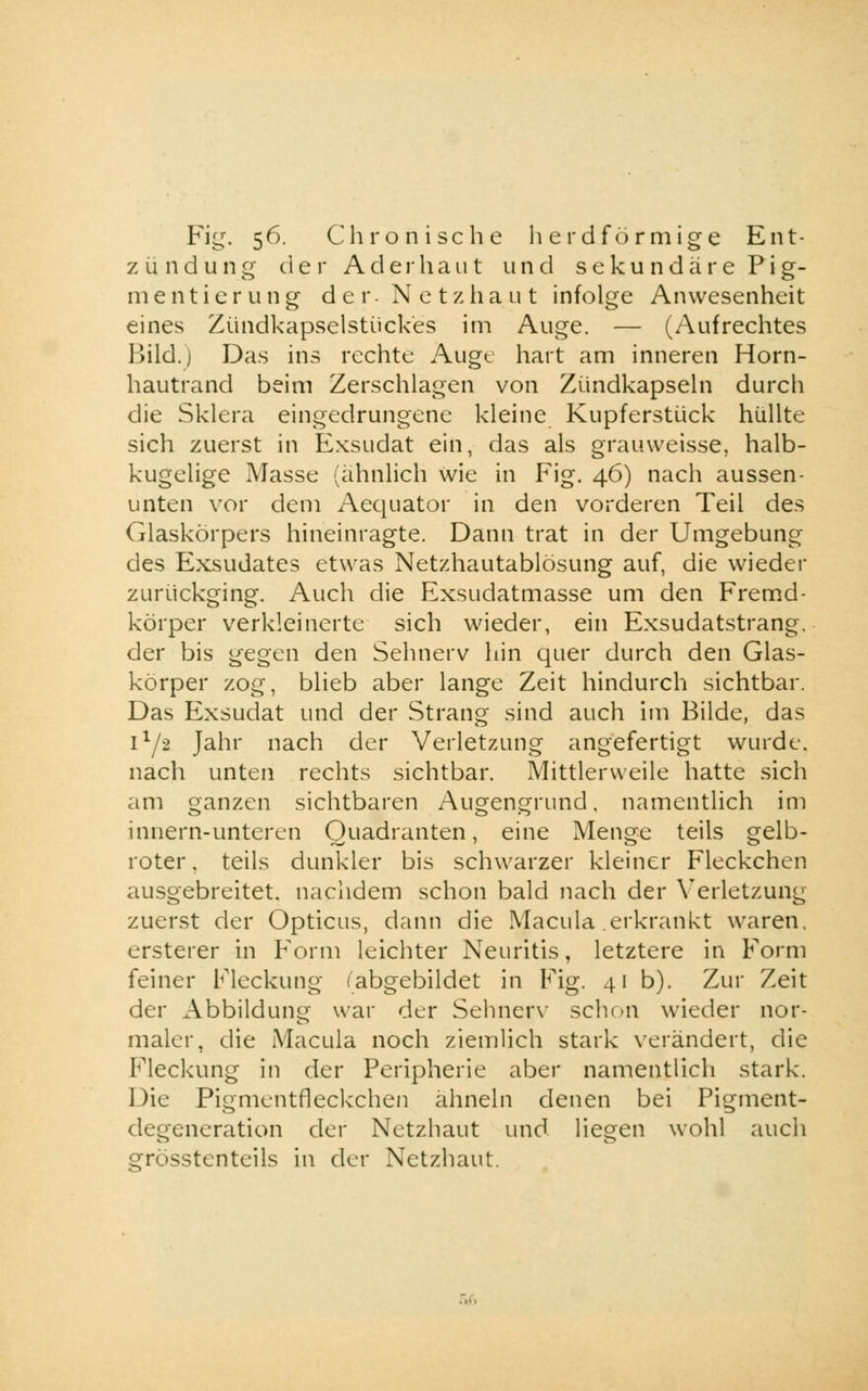 Fig. 56. Chronische herdförmige Ent- zündung der Ad er haut und seku ndäre Pig- menti er ung der Netzhaut infolge Anwesenheit eines Zündkapselstückes im Auge. — (Aufrechtes Bild.) Das ins rechte Auge hart am inneren Horn- hautrand beim Zerschlagen von Zündkapseln durch die Sklera eingedrungene kleine Kupferstück hüllte sich zuerst in Exsudat ein, das als grauweisse, halb- kugelige Masse (ähnlich wie in Fig. 46) nach aussen- unten vor dem Aequator in den vorderen Teil des Glaskörpers hineinragte. Dann trat in der Umgebung des Exsudates etwas Netzhautablösung auf, die wieder zurückging. Auch die Exsudatmasse um den Fremd- körper verkleinerte sich wieder, ein Exsudatstrang, der bis gegen den Sehnerv hin quer durch den Glas- körper zog, blieb aber lange Zeit hindurch sichtbar. Das Exsudat und der Strang sind auch im Bilde, das 1^2 Jahr nach der Verletzung angefertigt wurde, nach unten rechts sichtbar. Mittlerweile hatte sich am ganzen sichtbaren Augengrund, namentlich im innern-untcren Quadranten, eine Menge teils gelb- roter, teils dunkler bis schwarzer kleiner Fleckchen ausgebreitet, nachdem schon bald nach der Verletzung zuerst der Opticus, dann die Macula erkrankt waren, ersterer in Form leichter Neuritis, letztere in Form feiner Fleckung (abgebildet in Fig. 41 b). Zur Zeit der Abbildung war der Sehnerv schon wieder nor- maler, die Macula noch ziemlich stark verändert, die Fleckung in der Peripherie aber namentlich stark. Die Pigmentfleckchen ähneln denen bei Pigment- degeneration der Netzhaut und liegen wohl auch grösstenteils in der Netzhaut.