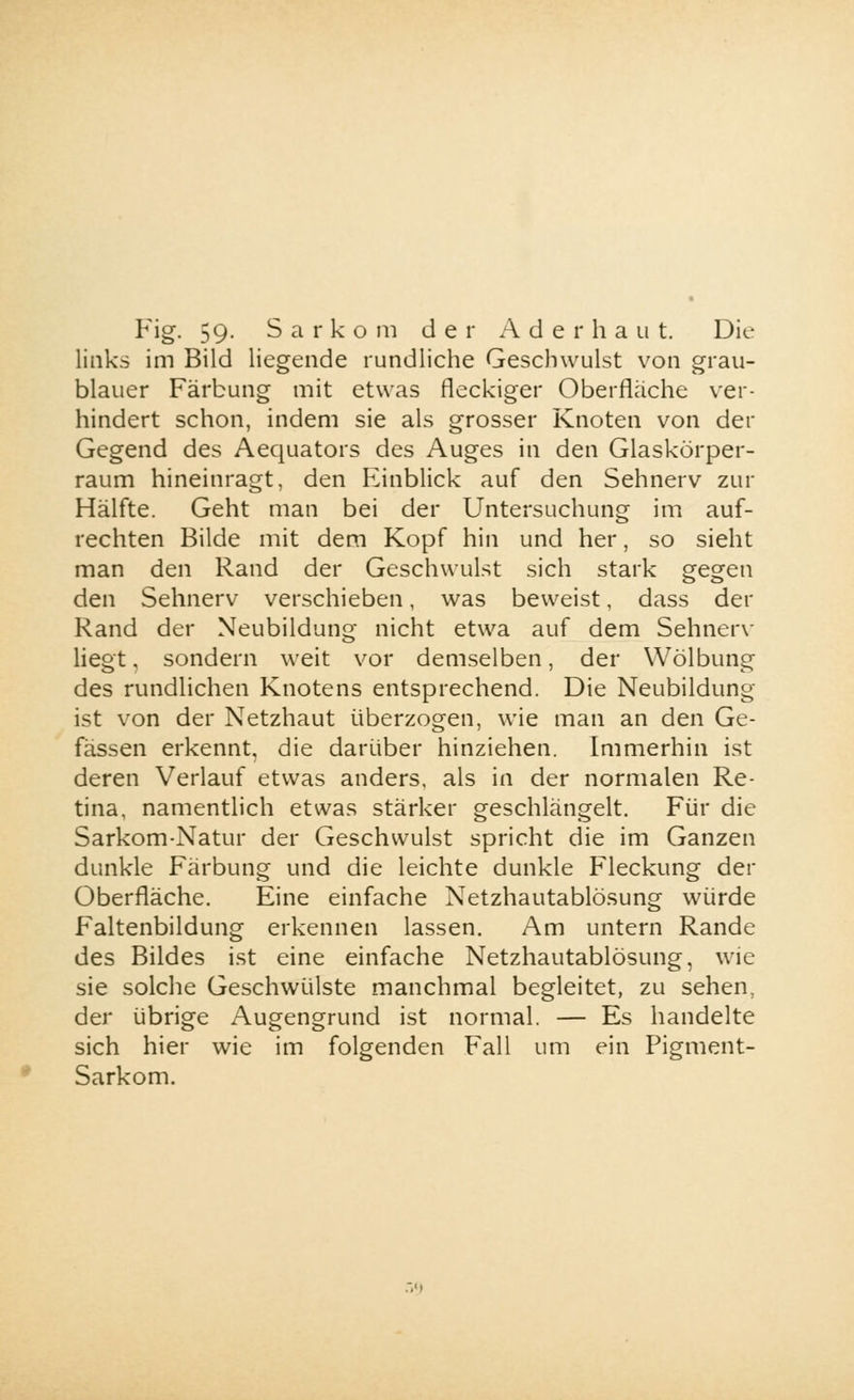 Fig« 59- Sarkom der A d e r h a u t. Die links im Bild liegende rundliche Geschwulst von grau- blauer Färbung mit etwas fleckiger Oberflache ver- hindert schon, indem sie als grosser Knoten von der Gegend des Aequators des Auges in den Glaskörper- raum hineinragt, den Einblick auf den Sehnerv zur Hälfte. Geht man bei der Untersuchung im auf- rechten Bilde mit dem Kopf hin und her, so sieht man den Rand der Geschwulst sich stark gegen den Sehnerv verschieben, was beweist, dass der Rand der Neubildung nicht etwa auf dem Sehnerv liegt, sondern weit vor demselben, der Wölbung des rundlichen Knotens entsprechend. Die Neubildung ist von der Netzhaut überzogen, wie man an den Ge- fässen erkennt, die darüber hinziehen. Immerhin ist deren Verlauf etwas anders, als in der normalen Re- tina, namentlich etwas stärker geschlängelt. Für die Sarkom-Natur der Geschwulst spricht die im Ganzen dunkle Färbung und die leichte dunkle Fleckung der Oberfläche. Eine einfache Netzhautablösung würde Faltenbildung erkennen lassen. Am untern Rande des Bildes ist eine einfache Netzhautablösung, wie sie solche Geschwülste manchmal begleitet, zu sehen, der übrige Augengrund ist normal. — Es handelte sich hier wie im folgenden Fall um ein Pigment- Sarkom.