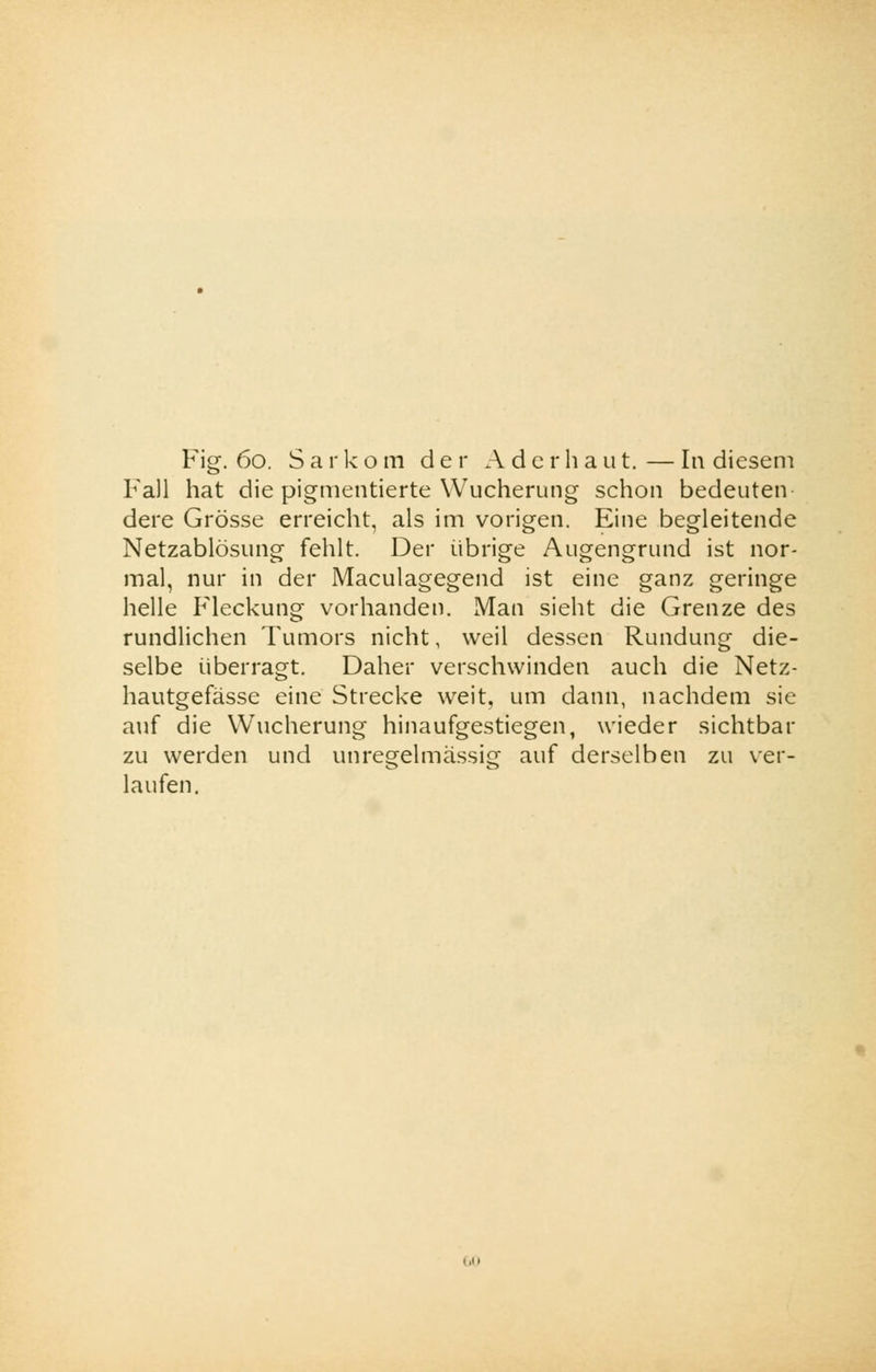 Fig. 60. Sarkom der Ader haut.—In diesem Fall hat die pigmentierte Wucherung schon bedeuten dere Grösse erreicht, als im vorigen. Eine begleitende Netzablösung fehlt. Der übrige Augengrund ist nor- mal, nur in der Maculagegend ist eine ganz geringe helle Fleckung vorhanden. Man sieht die Grenze des rundlichen Tumors nicht, weil dessen Rundung die- selbe überragt. Daher verschwinden auch die Netz- hautgefässe eine Strecke weit, um dann, nachdem sie auf die Wucherung hinaufgestiegen, wieder sichtbar zu werden und unregelmässig auf derselben zu ver- laufen.