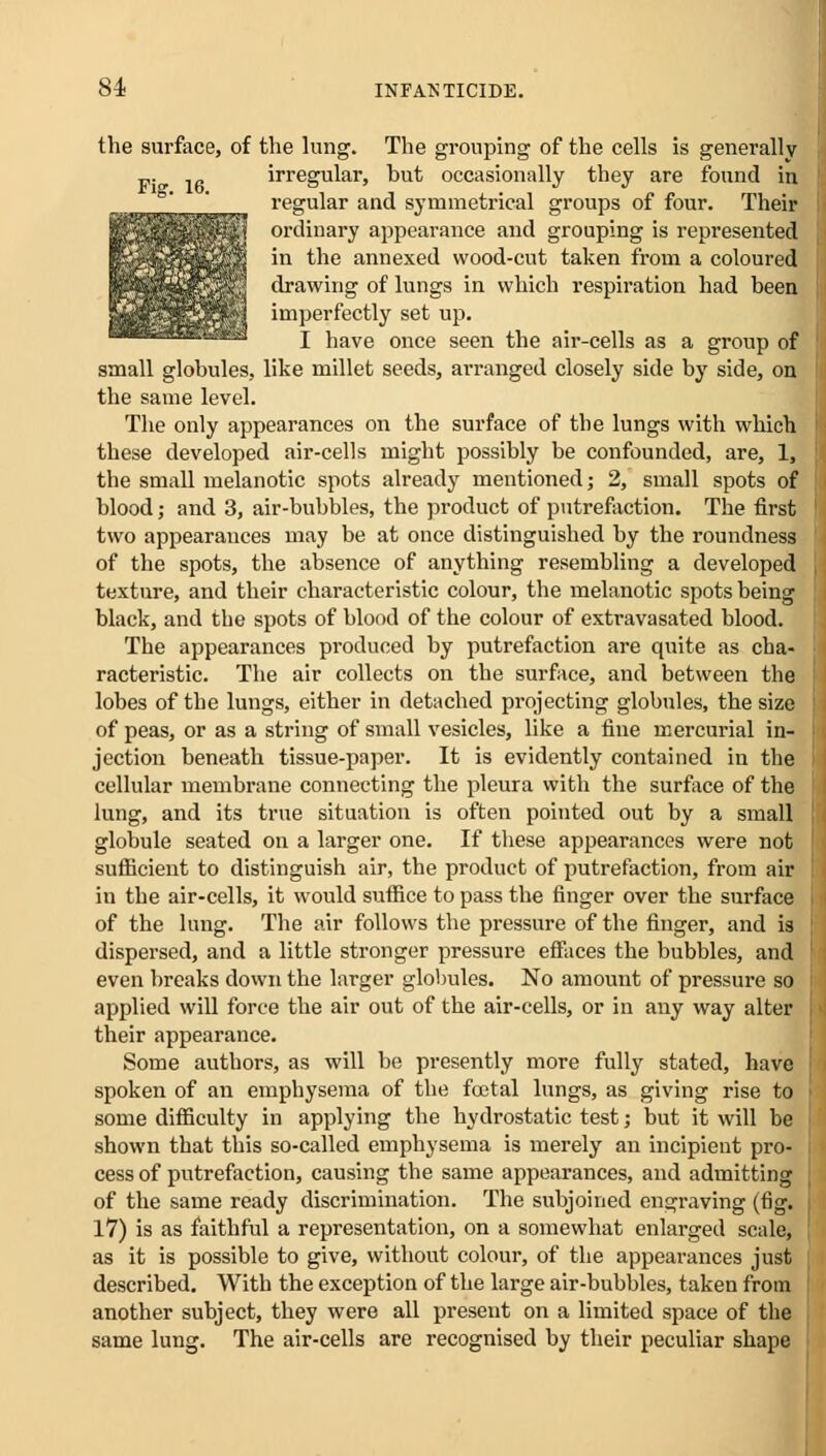 the surface, of the lung. The grouping of the cells is generally p. lfi irregular, but occasionally they are found in regular and symmetrical groups of four. Their ■^iHPiP ordinary appearance and grouping is represented OQkB in the annexed wood-cut taken from a coloured drawing of lungs in which respiration had been ■Bra l*SKi imperfectly set up. kSSEiasE^^a j have once seen the air-cells as a group of small globules, like millet seeds, arranged closely side by side, on the same level. The only appearances on the surface of the lungs with which these developed air-cells might possibly be confounded, are, 1, the small melanotic spots already mentioned} 2, small spots of blood; and 3, air-bubbles, the product of putrefaction. The first two appearances may be at once distinguished by the roundness of the spots, the absence of anything resembling a developed texture, and their characteristic colour, the melanotic spots being black, and the spots of blood of the colour of extravasated blood. The appearances produced by putrefaction are quite as cha- racteristic. The air collects on the surface, and between the lobes of the lungs, either in detached projecting globules, the size of peas, or as a string of small vesicles, like a fine mercurial in- jection beneath tissue-paper. It is evidently contained in the cellular membrane connecting the pleura with the surface of the lung, and its true situation is often pointed out by a small globule seated on a larger one. If these appearances were not sufficient to distinguish air, the product of putrefaction, from air in the air-cells, it would suffice to pass the finger over the surface of the lung. The air follows the pressure of the finger, and is dispersed, and a little stronger pressure effaces the bubbles, and even breaks down the larger globules. No amount of pressure so applied will force the air out of the air-cells, or in any way alter their appearance. Some authors, as will be presently more fully stated, have spoken of an emphysema of the foetal lungs, as giving rise to some difficulty in applying the hydrostatic test; but it will be shown that this so-called emphysema is merely an incipient pro- cess of putrefaction, causing the same appearances, and admitting of the same ready discrimination. The subjoined engraving (fig. 17) is as faithful a representation, on a somewhat enlarged scale, as it is possible to give, without colour, of the appearances just described. With the exception of the large air-bubbles, taken from another subject, they were all present on a limited space of the same lung. The air-cells are recognised by their peculiar shape
