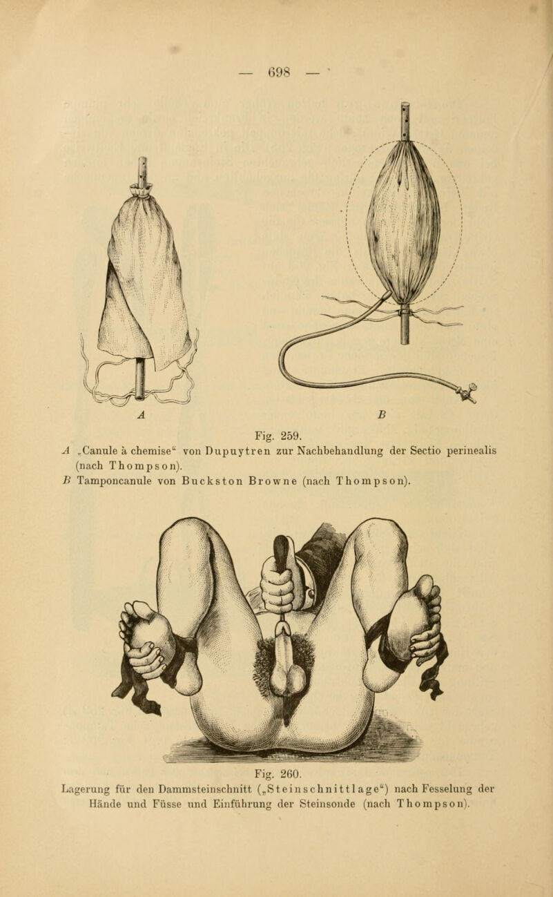 Fig. 259. A ..Canule a chemise von Dupuytren zur Nachbehandlung der Sectio perinealis (nach Thompson). B Tamponcanule von Buckston Browne (nach Thompson). Fig. 260. Lagerung für den Dammsteinschnitt (^Steinschnitt I age) nach Fesselung der Hände und Füsse und Einführung der Steinsonde (nach Thompson).