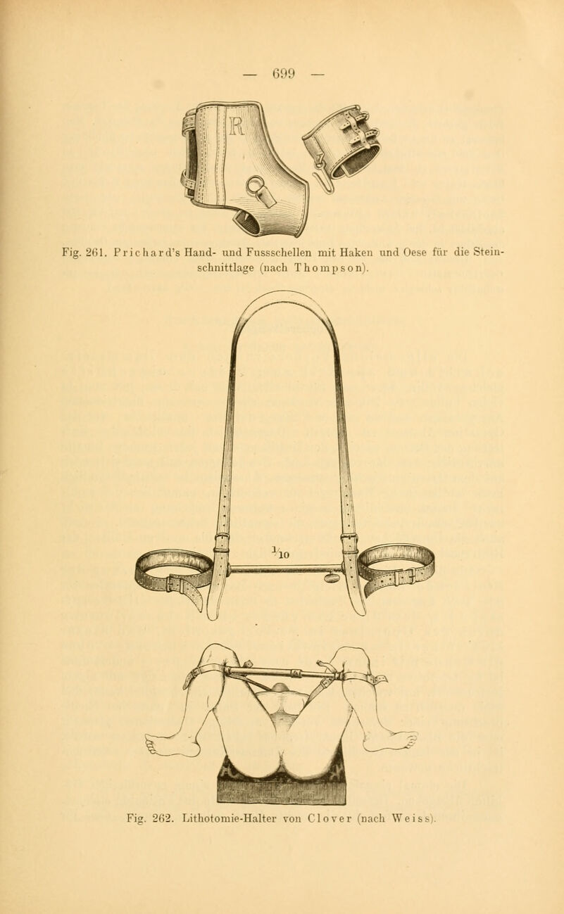 Fig. 261. Prichard's Hand- und Fussschellen mit Haken und Oese für die Stein- schnittlage (nach Thompson). Fig. 262. Lithotomie-Halter von Clover (nach Weiss).