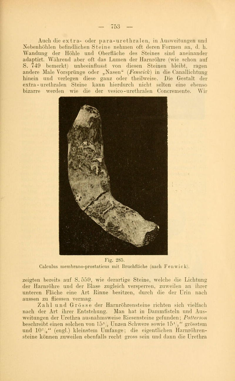 Auch die extra- oder para-urethralen, in Ausweitungen und Nebenhöhlen befindlichen Steine nehmen oft deren Formen an, d. h. Wandung der Höhle und Oberfläche des Steines sind aneinander adaptirt. Während aber oft das Lumen der Harnröhre (wie schon auf S. 749 bemerkt) unbeeinflusst von diesen Steinen bleibt, ragen andere Male Vorsprünge oder „Nasen (Fetiicick) in die Canallichtung hinein und verlegen diese ganz oder theilweise. Die Gestalt der extra-urethralen Steine kann hierdurch nicht selten eine ebenso bizarre werden wie die der vesico-urethralen Concremente. Wir Fig. 285. Calculus membrano-prostaticus mit Bruchfläche (nach Fenwick). zeigten bereits auf S. 559, wie derartige Steine, welche die Lichtung der Harnröhre und der Blase zugleich versperren, zuweilen an ihrer unteren Fläche eine Art Rinne besitzen, durch die der Urin nach aussen zu fliessen vermag. Zahl und Grösse der Harnröhrensteine richten sich vielfach nach der Art ihrer Entstehung. Man hat in Dammfisteln und Aus- weitungen der Urethra ausnahmsweise Riesensteine gefunden; Patterson beschreibt einen solchen von 15V.j Unzen Schwere sowie 15^ o grösstem und lO^s (engl.) kleinstem Umfange; die eigentlichen Harnröhren- steine können zuweilen ebenfalls recht gross sein und dann die Urethra