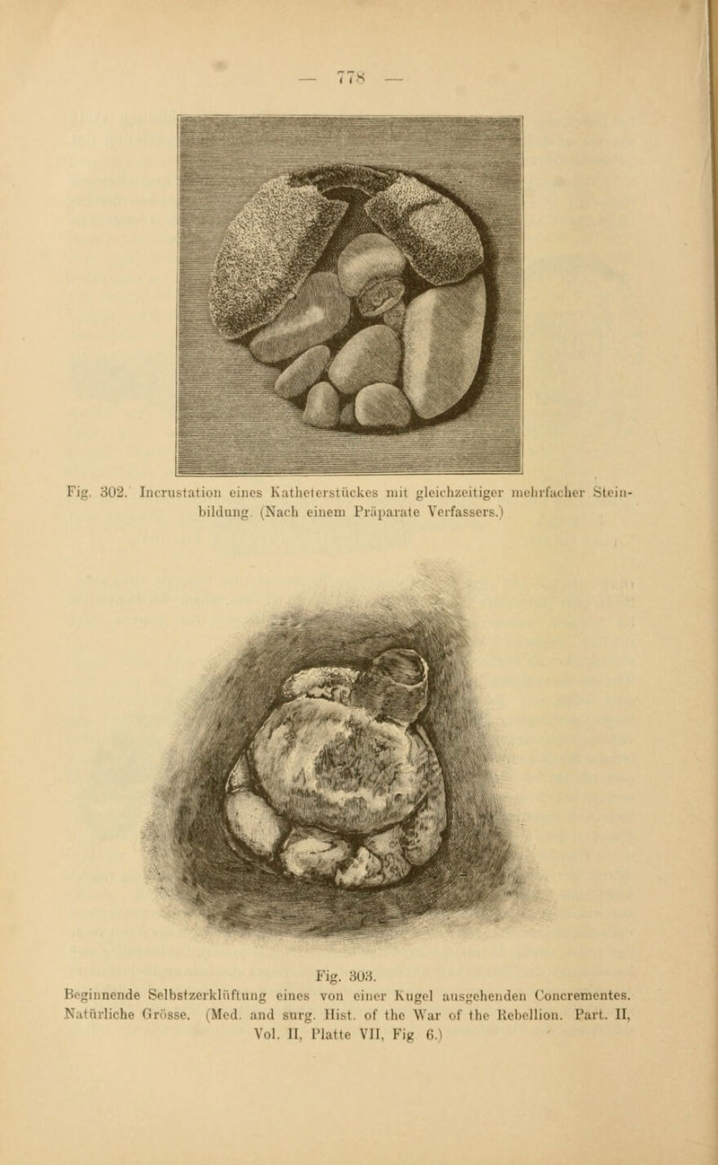 Fig. 302.' Incrustation eines Katheterstückes mit gleichzeitiger mehrfacher Steiii- bilclung. (Nach einem Präparate Verfassers.) Fig. 3U3. Beginnende Selbstzerkliiftuiig eines von einer Kugel ausziehenden Concrementes. Natürliche Grösse. (Med. and surg. Hist. of the War of the Rebellion. Part. II, Vol. II, Platte VII, Fig 6.)