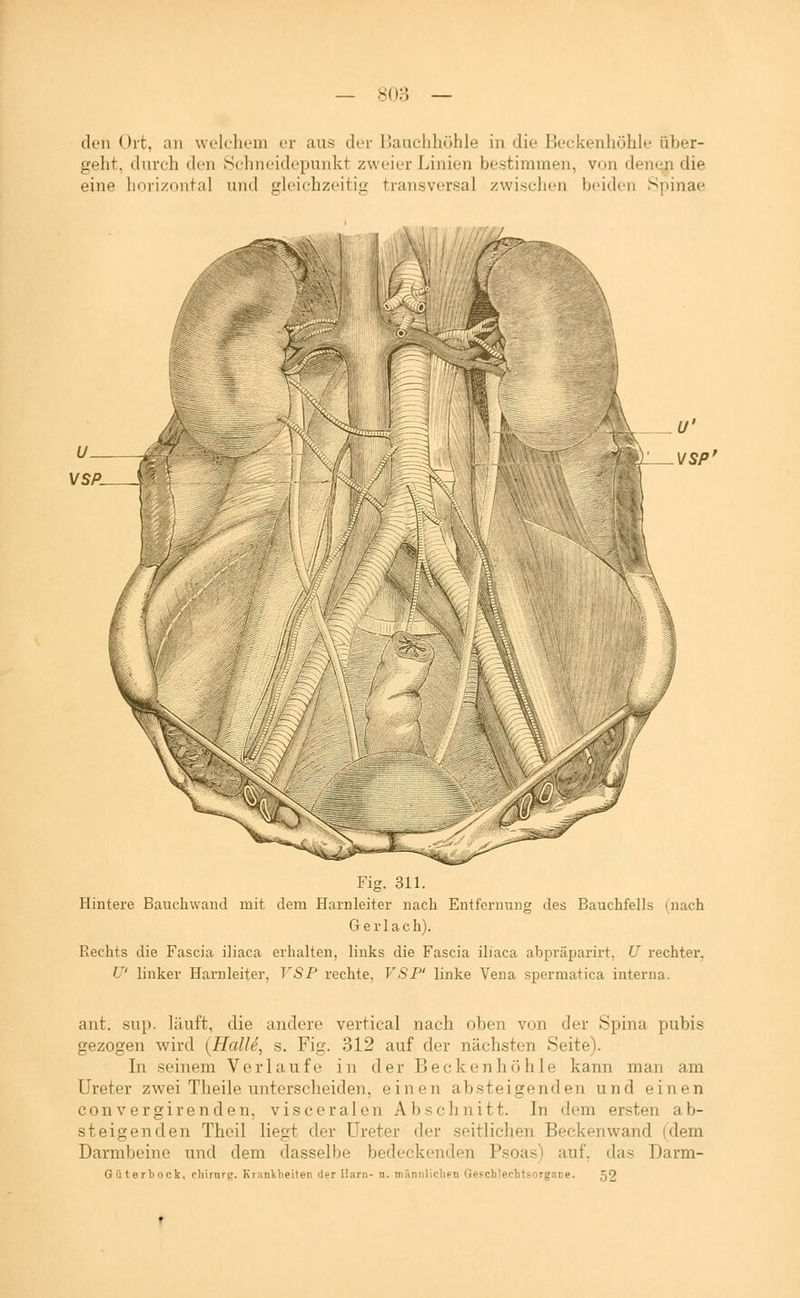 — 8()o — den Ort, an welchem er aus der Bauchhöhle in die Beckenhöhle iiher- geht, durch den Schneidepunkt zweier Linien bestimmen, vun denen die eine liorizontal und gleichzeitig transversal zwischen beiden Spinae : \/sp' VSP^ Fig. 311. Hintere Bauchvvand mit dem Harnleiter nach Entfernung des Bauchfells (nach Gerlach). Rechts die Fascia iliaca erhalten, links die Fascia iliaca abpräparirt, U rechter. U' linker Harnleiter, TSP rechte, VSP' linke Vena spormatica interna. ant. sup. läuft, die andere vertical nach oben von der Spina pubis gezogen wird (Halle, s. Fig. 312 auf der nächsten Seite). In seinem Verlaufe in der Becken höhle kann man am Ureter zwei Theile unterscheiden, einen absteigenden und einen eonvergirenden, visceralen Abschnitt. In dem ersten ab- steigenden Theil liegt der Ureter der seitlichen Beckenwand (dem Darmbeine und dem dasselbe bedeckenden Psoas) auf, das Darm- Güterbock, chirnrc. Krankheiten der Harn- n. männlichen Geschlechtsorgane. 52