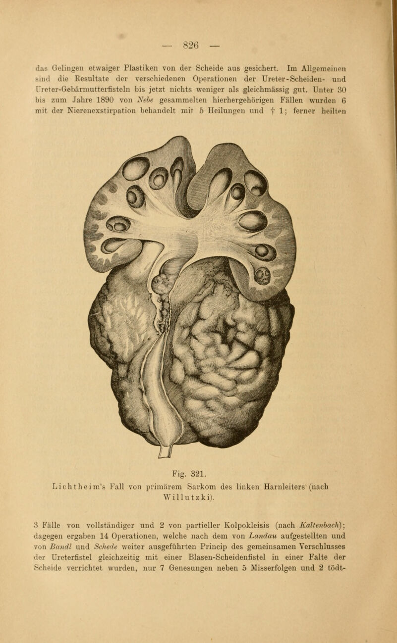 das Gelingen etwaiger Plastiken von der Scheide aus gesichert. Im Allgemeinen sind die Resultate der verschiedenen Operationen der Ureter-Scheiden- und Üreter-Gebärmutterfisteln bis jetzt nichts weniger als gleichmässig gut. Unter 30 bis zum Jahre 1890 von Nebe gesammelten hierhergehörigen Fällen wurden 6 mit der Nierenexstirpation behandelt mit 5 Heilungen und f 1; ferner heilten Fig. 321. Lichtheim's Fall von primärem Sarkom des linken Harnleiters (nach Willutzki). 3 Fälle von vollständiger und 2 von partieller Kolpokleisis (nach Kaltenhach); dagegen ergaben 14 Operationen, welche nach dem von Landau aufgestellten und von Bandl und Schede weiter ausgeführten Princip des gemeinsamen Verschlusses der Ureterfistel gleichzeitig mit einer Blasen-Scheidenfistel in einer Falte der Scheide verrichtet wurden, nur 7 Genesungen neben 5 Misserfolgen und 2 tödt-