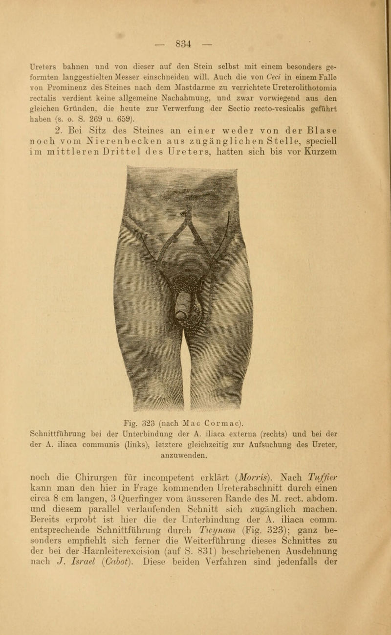 Ureters bahnen und von dieser auf den Stein selbst mit einem besonders ge- formten langgestieltcn Messer einschneiden will. Auch die von Ceci in einem Falle von Prominenz des Steines nach dem Mastdarme zu verrichtete Ureterolithotomia rectalis verdient keine allgemeine Nachahmung, und zwar vorwiegend aus den gleichen Gründen, die heute zur Verwerfung der Sectio recto-vesicalis geführt haben (s. o. S. 269 u. 659). 2. Bei Sitz des Steines an einer weder von d e r B1 a s e noch vom Nierenbecken aus zugänglichen Stelle, speciell im mittleren Drittel des Ureters, hatten sich bis vor Kurzem Fig. 323 (nach Mac Cormac). Schnittführung bei der Unterbindung der A. iliaca externa (rechts) und bei der der A. iliaca communis (links), letztere gleichzeitig zur Aufsuchung des Ureter, anzuwenden. noch die Cliirurgen für inconipetent erklärt (Morris). Nach Tufßer kann man den hier in Frage kommenden Ureterabschnitt durch einen circa 8 cm langen, 8 Querfinger vom äusseren Rande des M. rect. abdom. und diesem parallel verlaufenden Schnitt sich zugänglich machen. Bereits erprobt ist hier die der Unterbindung der A. iliaca comm. entsprechende Schnittführung durch Twijnam (Fig. 323); ganz be- sonders empfiehlt sich ferner die Weiterführung dieses Schnittes zu der bei der-Harnleiterexcision (auf S. 831) beschriebenen Ausdehnung nach J. Israel {Cabot). Diese beiden Verfahren sind jedenfalls der