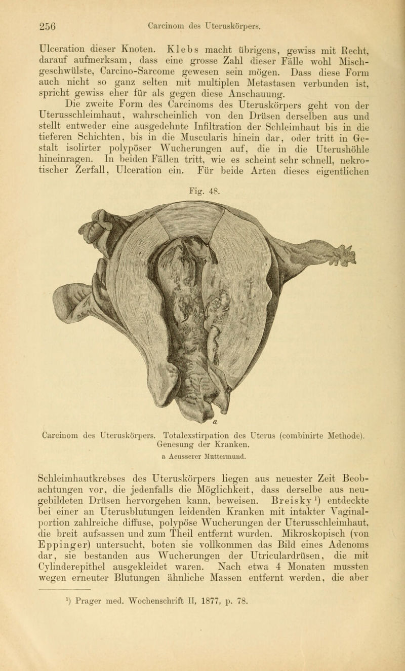 Ulceration dieser Knoten. Kleb8 macht übrigens, gewiss mit Recht, darauf aufmerksam, class eine grosse Zahl dieser Fälle wohl Misch- geschwülste, Carcino-Sarcome gewesen sein mögen. Dass diese Form auch nicht so ganz selten mit multiplen Metastasen verbunden ist, spricht gewiss eher für als gegen diese Anschauung. Die zweite Form des Carcinoms des Uteruskörpers geht von der Uterusschleimhaut, wahrscheinlich von den Drüsen derselben aus und stellt entweder eine ausgedehnte Infiltration der Schleimhaut bis in die tieferen Schichten, bis in die Muscularis hinein dar, oder tritt in Ge- stalt isolirter polypöser Wucherungen auf, die in die Uterushöhle hineinragen. In beiden Fällen tritt, wie es scheint sehr schnell, nekro- tischer Zerfall, Ulceration ein. Für beide Arten dieses eigentlichen Fig. 48. ■\TV Carcinom des Uteruskörpers. Totalexstirpation des Uterus (combinirte Methode). Genesung der Kranken. a Aeusserer Muttermund. Schleimhautkrebses des Uteruskörpers liegen aus neuester Zeit Beob- achtungen vor, die jedenfalls die Möglichkeit, dass derselbe aus neu- gebildeten Drüsen hervorgehen kann, beweisen. Breisky1) entdeckte bei einer an Uterusblutungen leidenden Kranken mit intakter Vaginal- portion zahlreiche diffuse, polypöse Wucherungen der Uterusschleimhaut, die breit aufsassen und zum Theil entfernt wurden. Mikroskopisch (von Eppinger) untersucht, boten sie vollkommen das Bild eines Adenoms dar, sie bestanden aus Wucherungen der Utriculardrüsen, die mit Cylinderepithel ausgekleidet waren. Nach etwa 4 Monaten mussten wegen erneuter Blutungen ähnliche Massen entfernt werden, die aber J) Prager med. Wochenschrift II, 1877, p. 78.