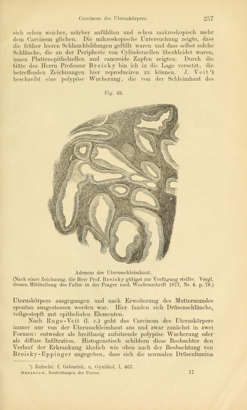 sich schon weicher, mürber anfühlten und schon makroskopisch mehr dem Carcinom glichen. Die mikroskopische Untersuchung zeigte, dass die früher leeren Schlauchbildungen gefüllt waren und dass selbst solche Schläuche, die an der Peripherie von Cylinderzellen überkleidet waren, innen Plattenepithelzellen und cancroide Zapfen zeigten. Durch die Güte des Herrn Professor Breisky bin ich in die Lage versetzt, die betreffenden Zeichnungen hier reproduciren zu können. J. Veit1) beschreibt eine polypöse Wucherung, die von der Schleimhaut des Fig. 49. Adenom der Uterusschleimhaut. (Nach einer Zeichnung, die Herr Prof. Breisky gütigst zur Verfügung stellte. Vergl. dessen Mittheilung des Falles in der Prager med. Wochenschrift 1877, Nr. 4, p. 78.) Uteruskörpers ausgegangen und nach Erweiterung des Muttermundes spontan ausgestossen worden war. Hier fanden sich Drüsenschläuche, vollgestopft mit epithelialen Elementen. Nach Rüge-Veit (1. c.) geht das Carcinom des Uteruskörpers immer nur von der Uterusschleimhaut aus und zwar zunächst in zwei Formen: entweder als breitbasig aufsitzende polypöse Wucherung oder als diffuse Infiltration. Histogenetisch schildern diese Beobachter den Verlauf der Erkrankung ähnlich wie oben nach der Beobachtung von Breisky-Eppinger angegeben, dass sich die normalen Drüsenlumina :) Zeitschi*, f. Geburtsh. u. Gynäkol. I, 467. Gusserow, Neubildungen des Uterus. 17